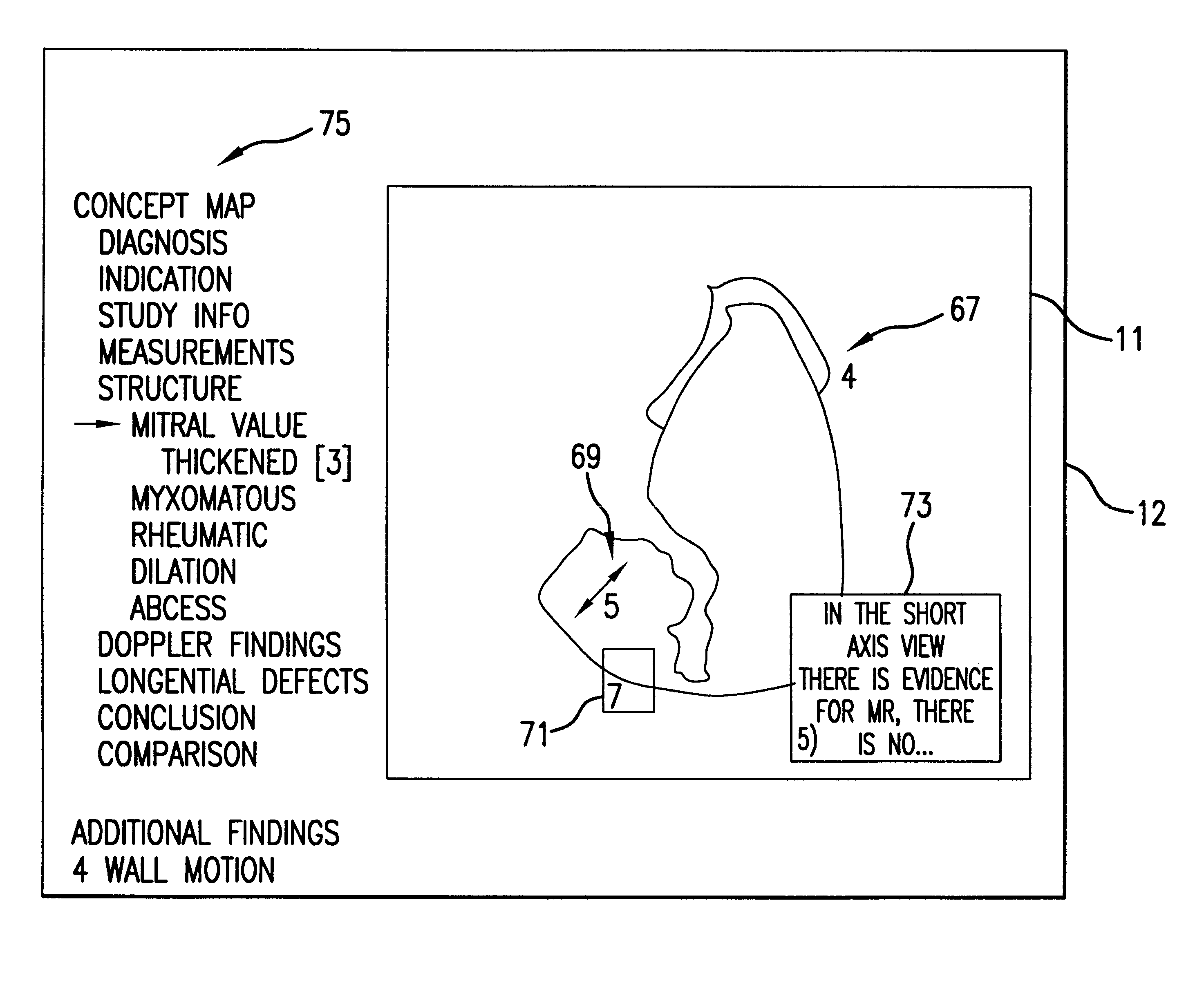 Iterative video teaching aid with recordable commentary and indexing