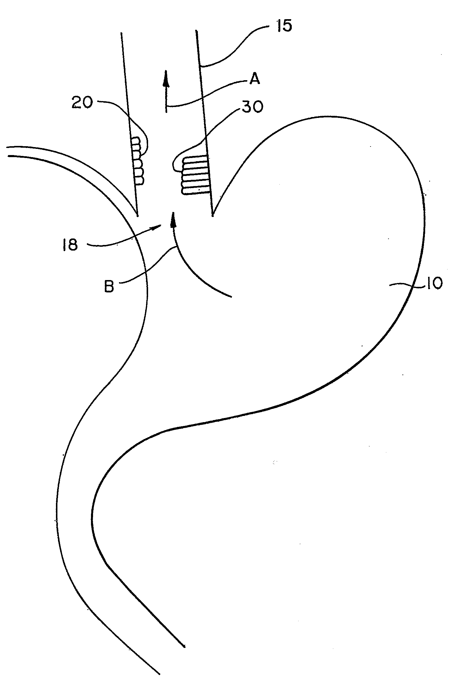 System and method of treating abnormal tissue in the human esophagus