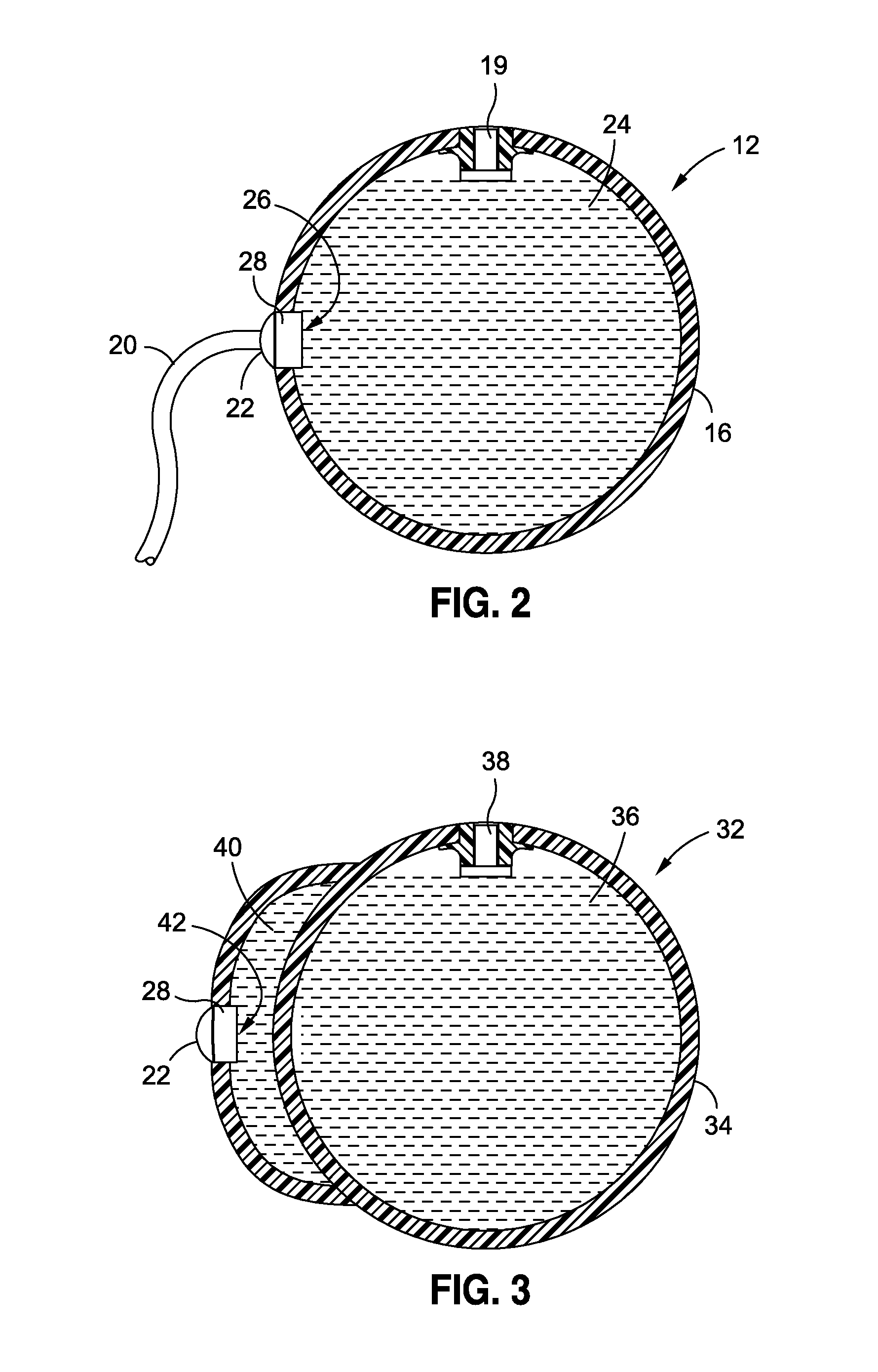 Intragastric volume occupying device with active agents