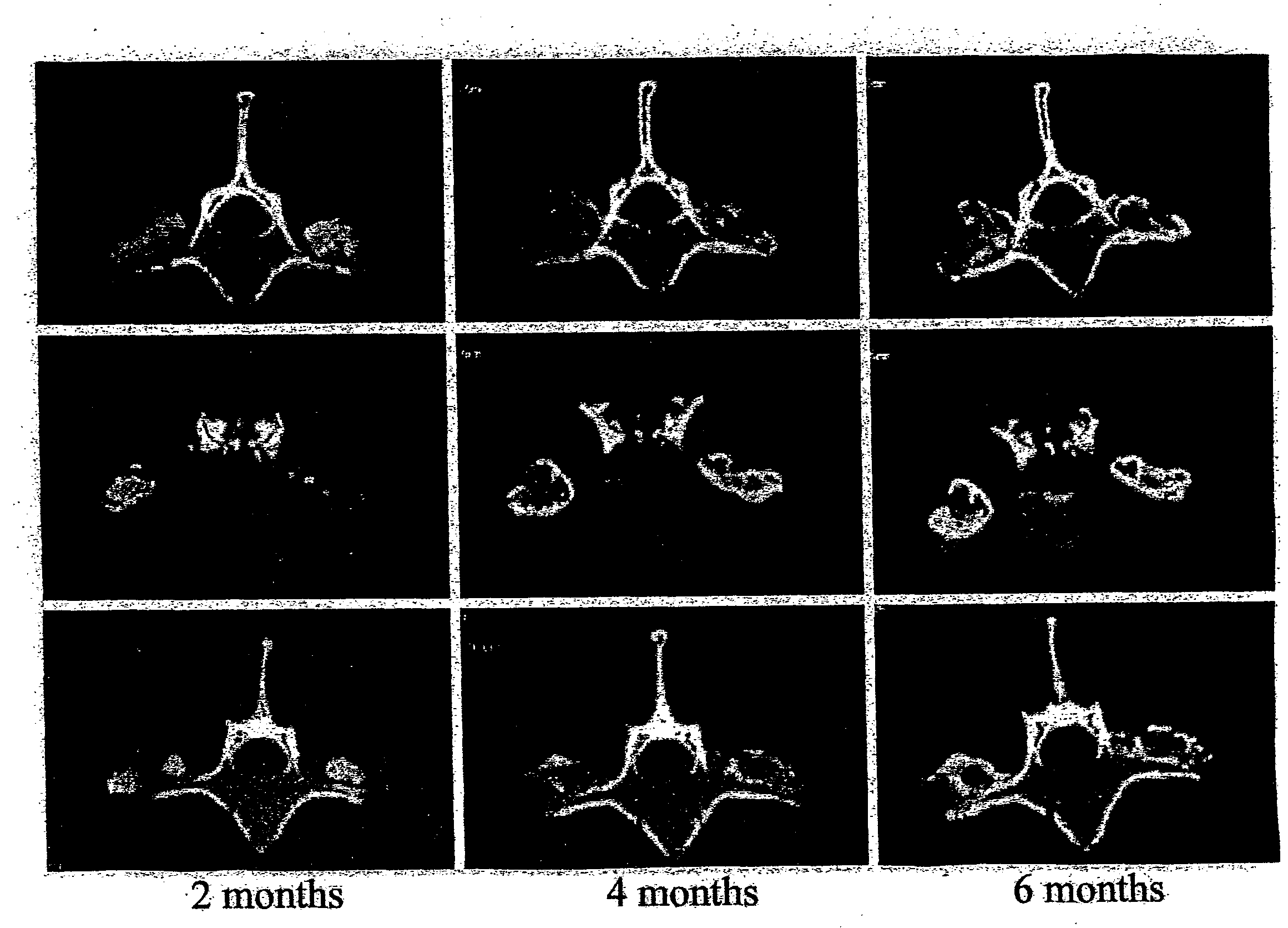 Spinal fusion methods and devices