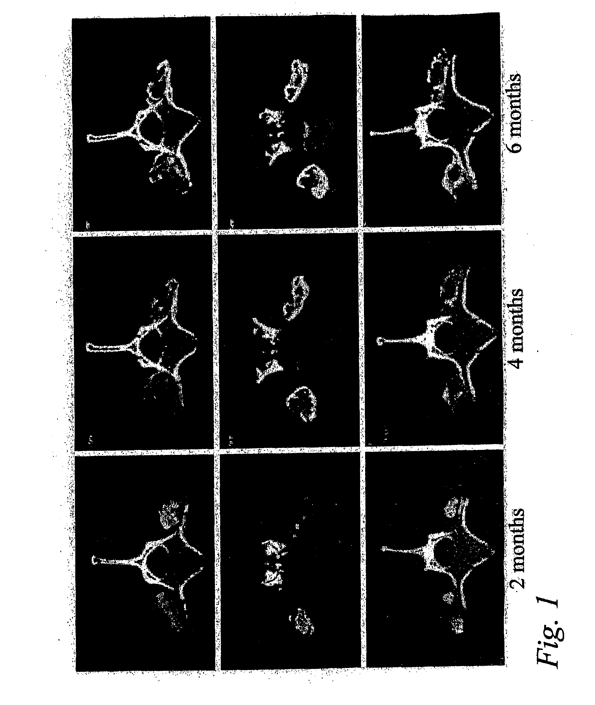 Spinal fusion methods and devices