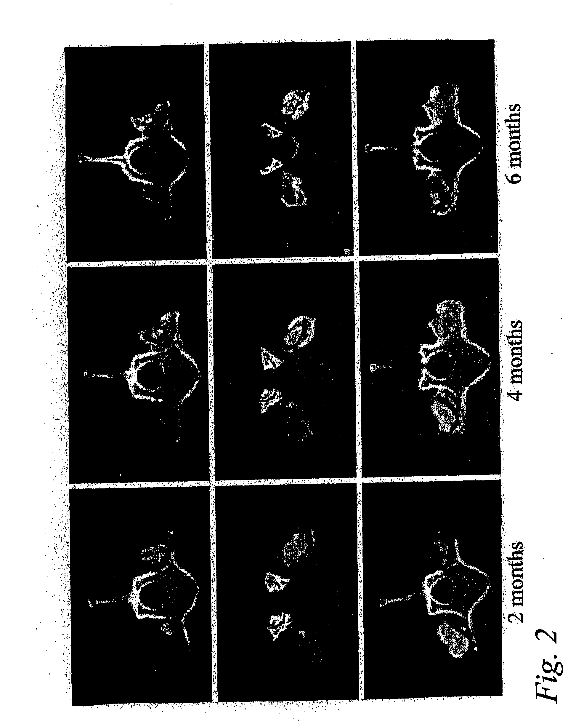 Spinal fusion methods and devices