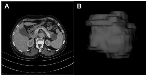 Construction method of imaging omics model for pancreatic cancer prediction