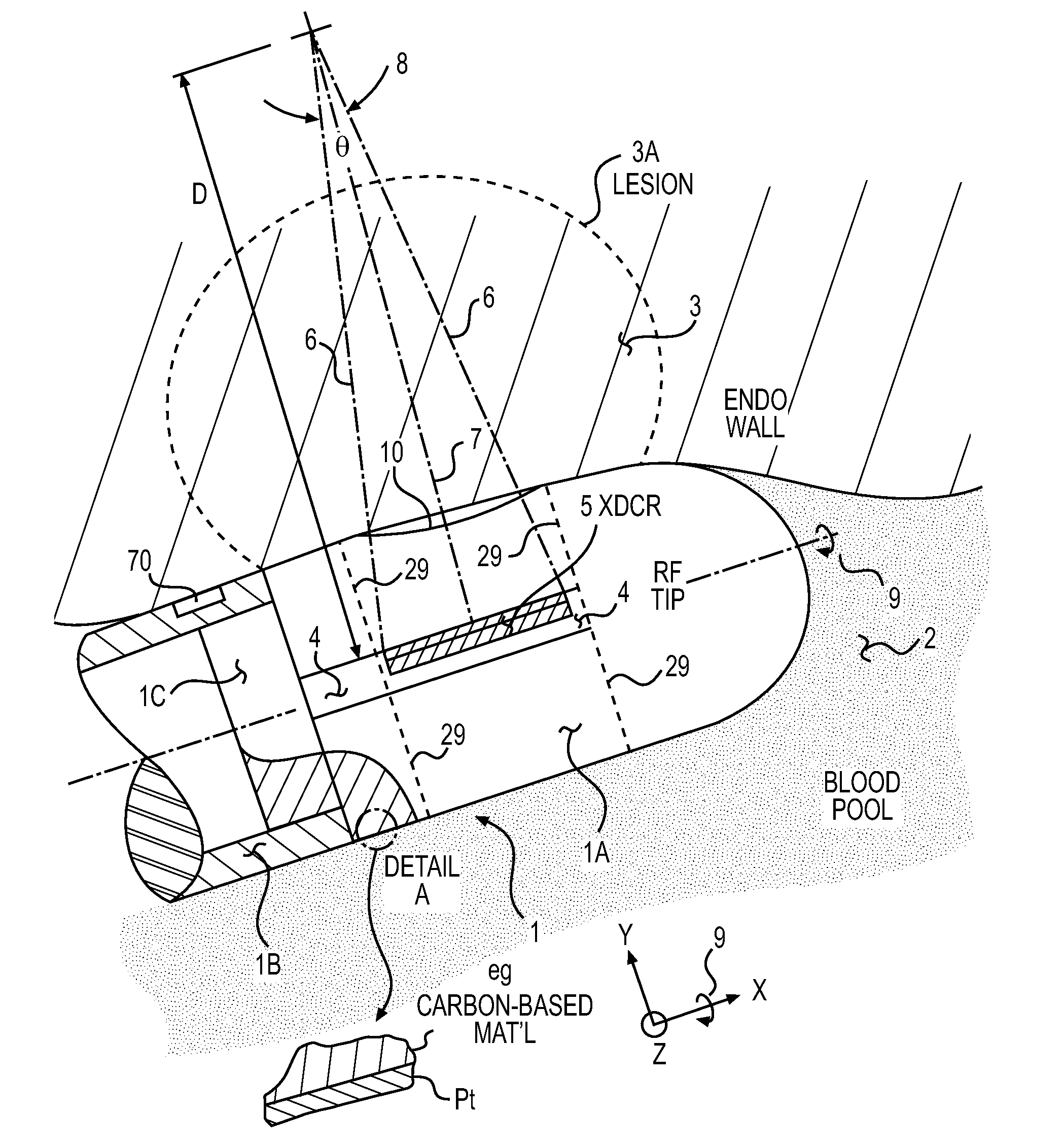 Acoustic transducer for pulse-echo monitoring and control of thermally ablative lesioning in layered and nonlayered tissues, catheter contact monitoring, tissue thickness measurement and pre-pop warning