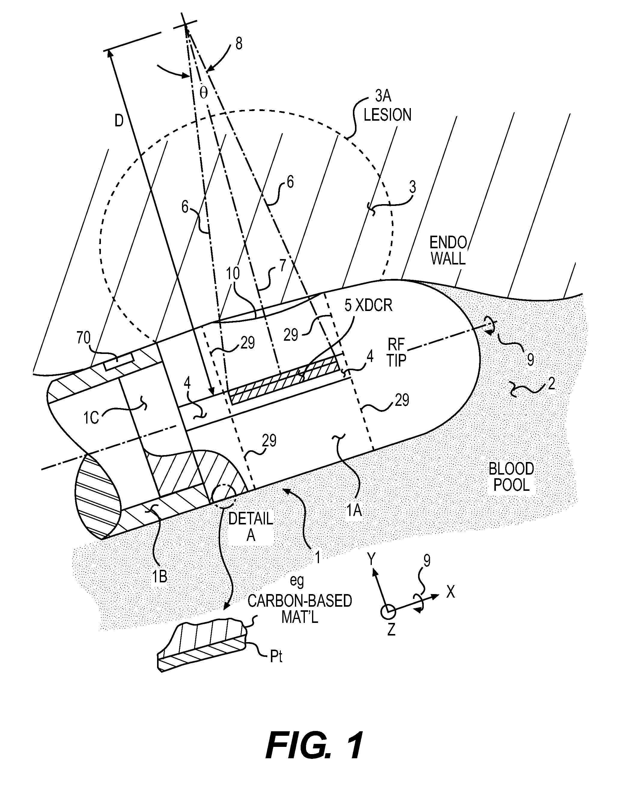 Acoustic transducer for pulse-echo monitoring and control of thermally ablative lesioning in layered and nonlayered tissues, catheter contact monitoring, tissue thickness measurement and pre-pop warning