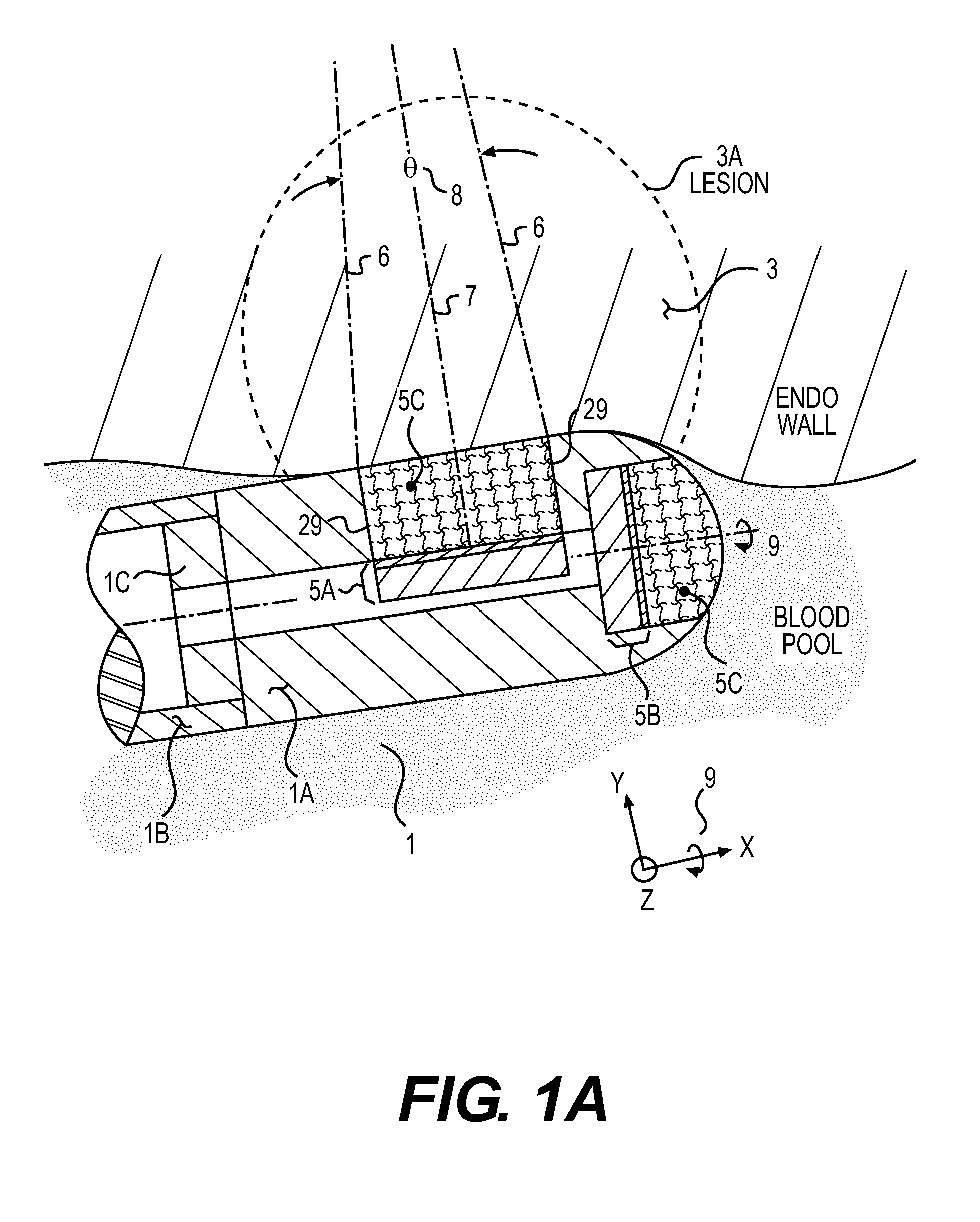 Acoustic transducer for pulse-echo monitoring and control of thermally ablative lesioning in layered and nonlayered tissues, catheter contact monitoring, tissue thickness measurement and pre-pop warning