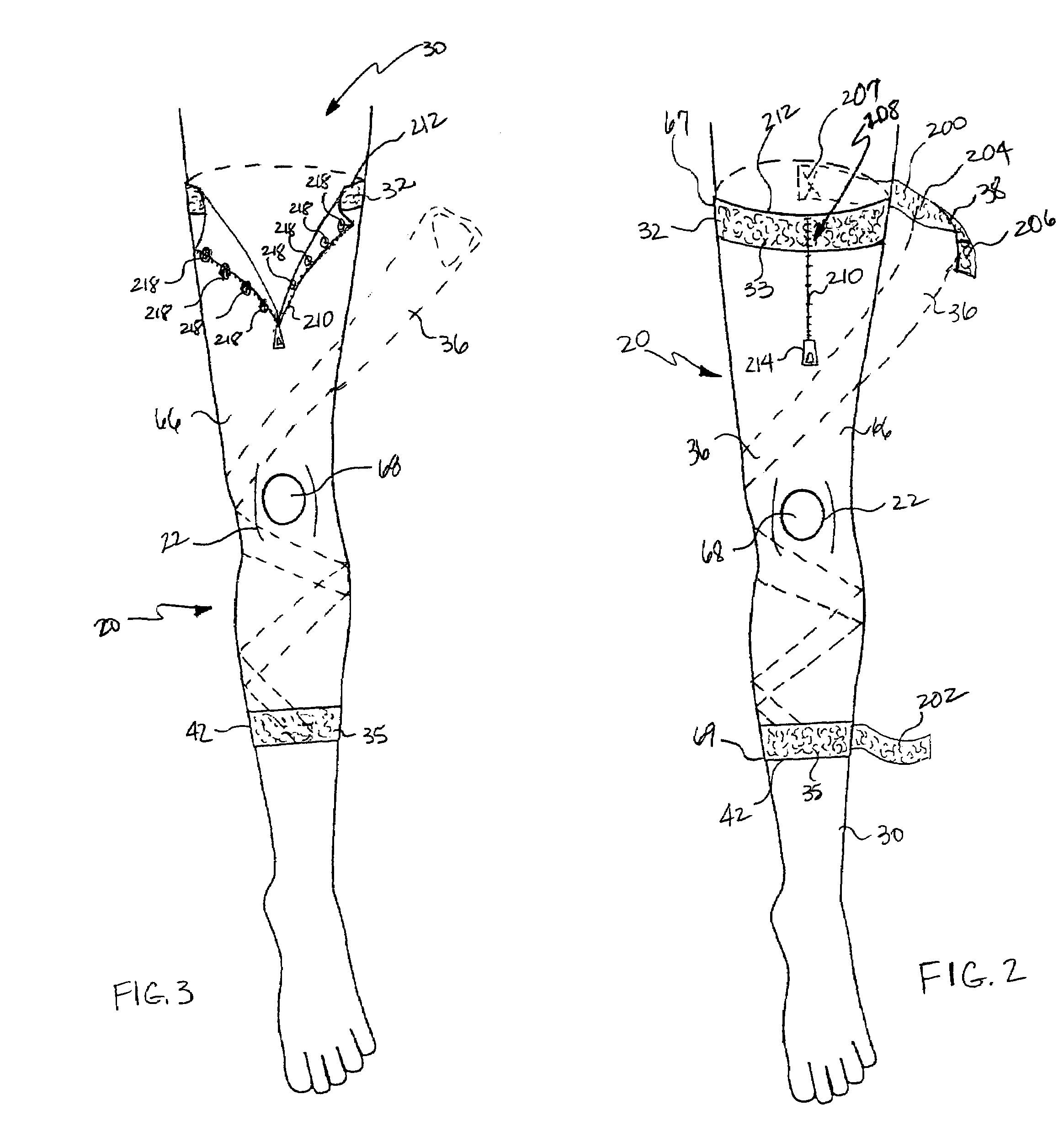 Variably adjustable bi-directional derotation bracing system