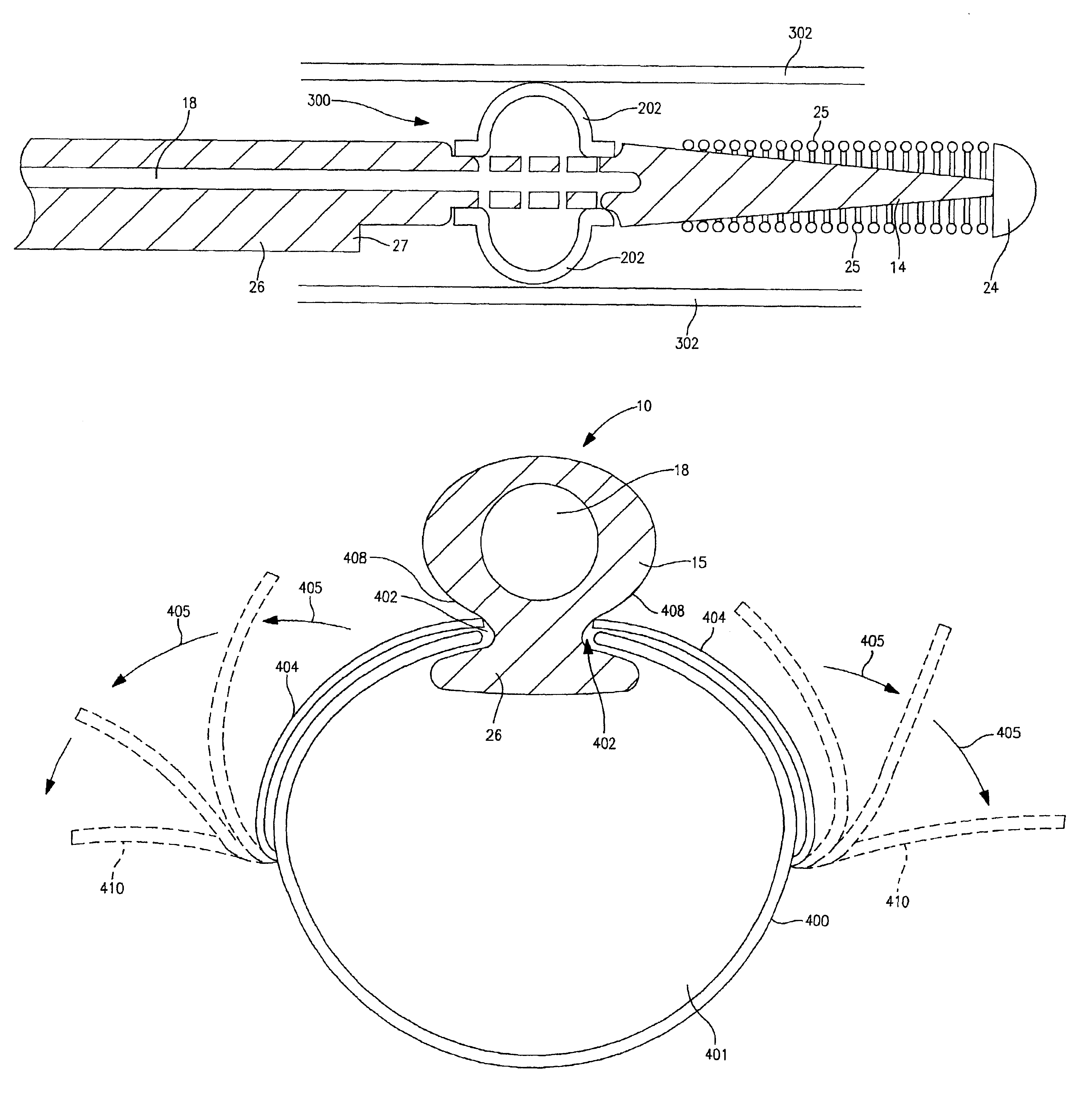 System and method for placing endocardial leads