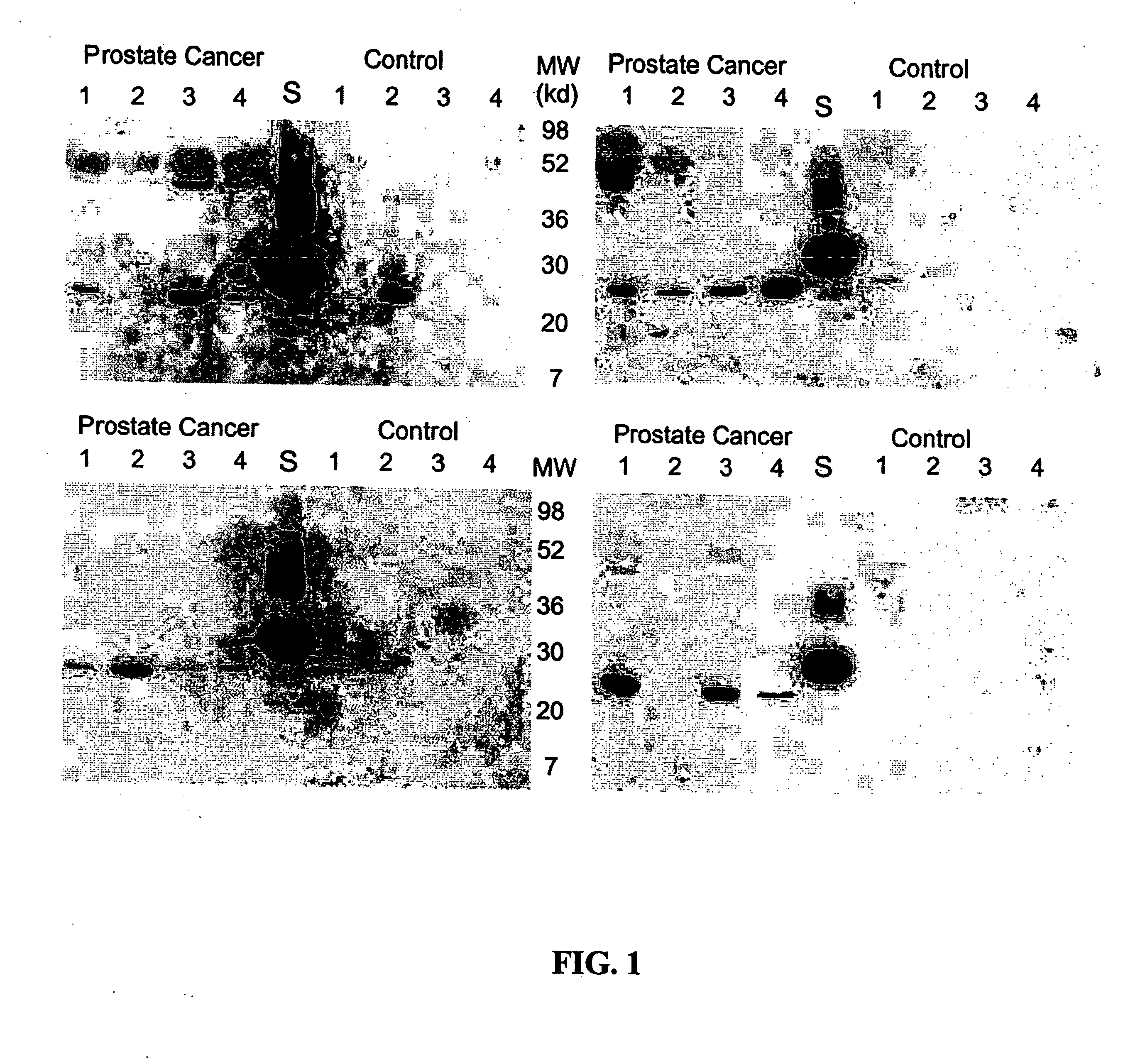 Methods and compositions for diagnosis and monitoring of prostate cancer progression by detection of serum caveolin