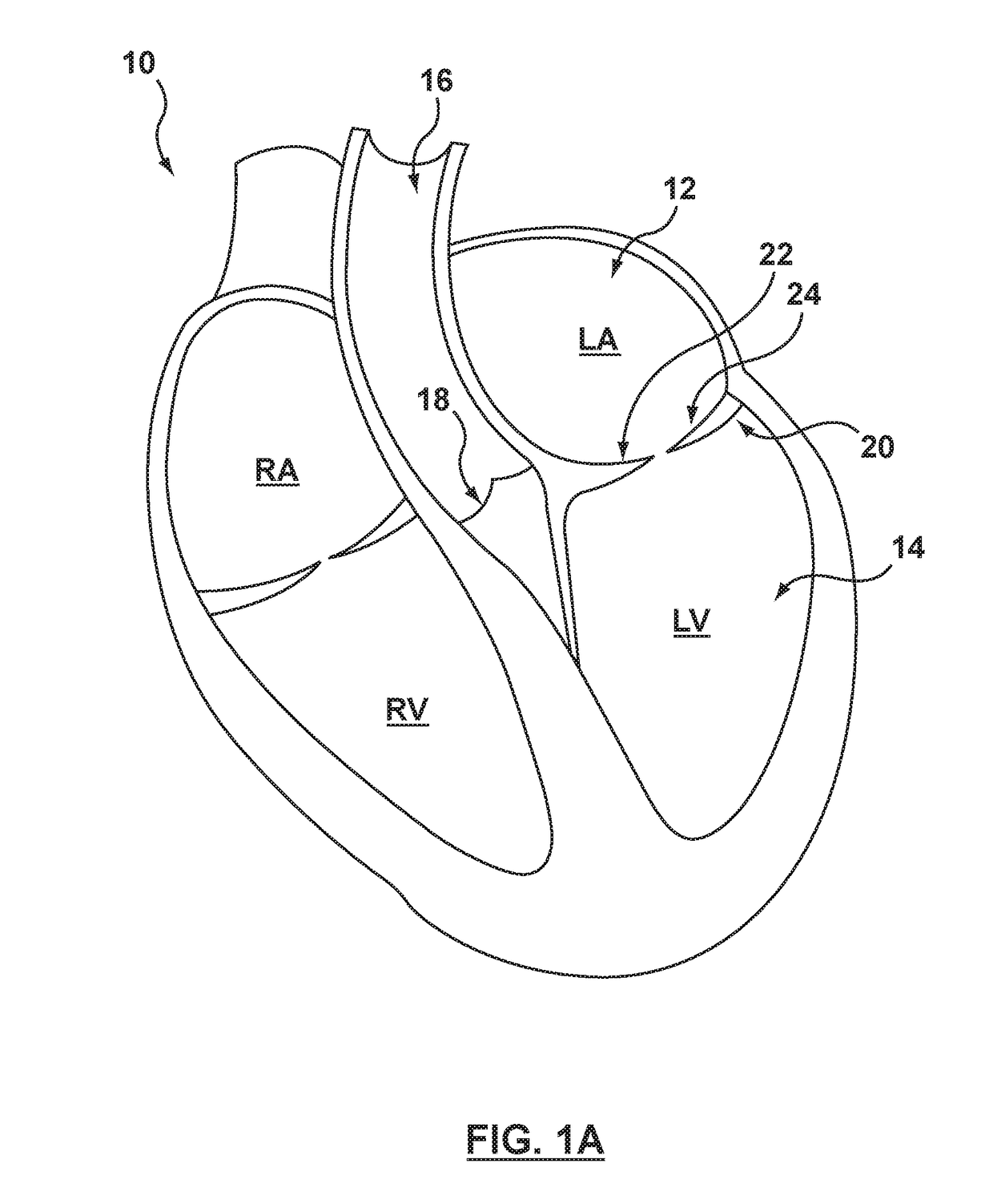 Helical coil mitral valve annuloplasty systems and methods