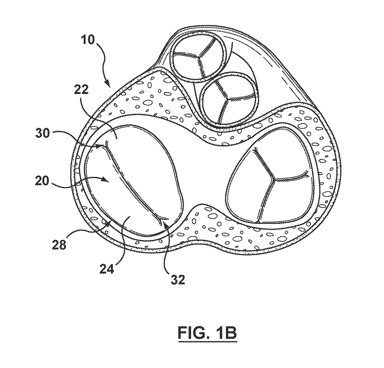 Helical coil mitral valve annuloplasty systems and methods