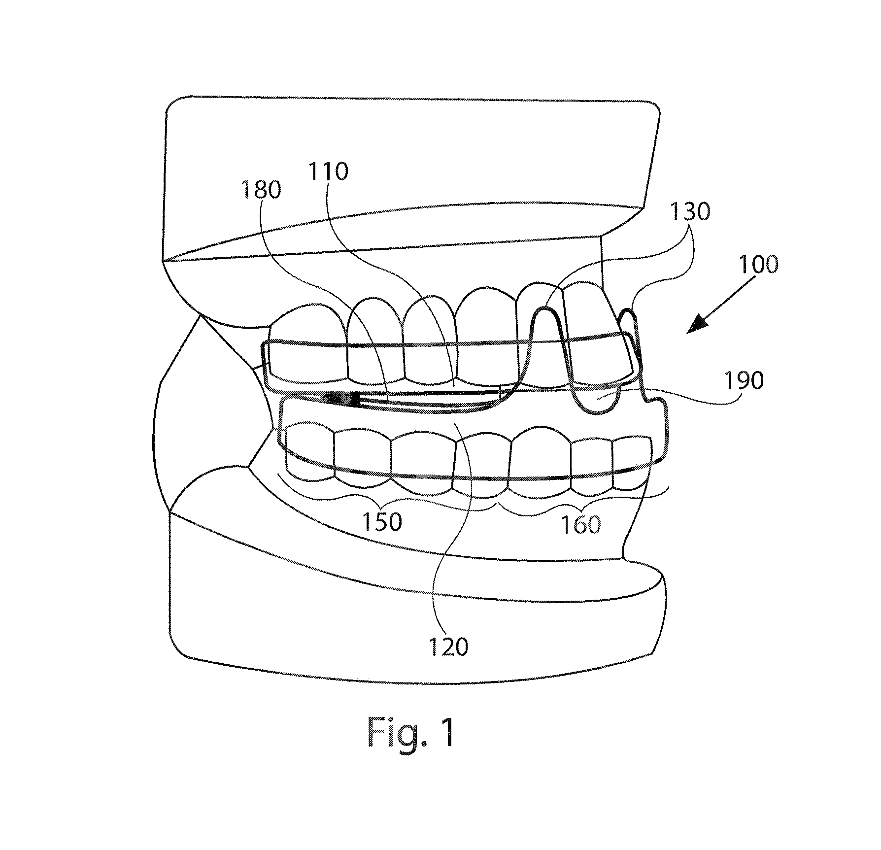 Mandibular advancement device