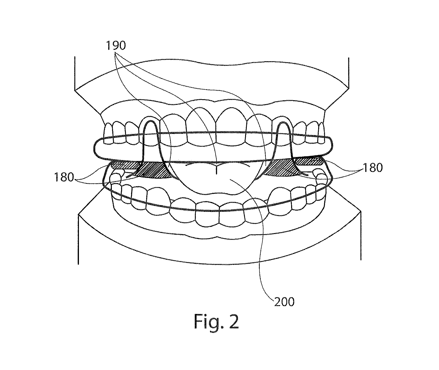 Mandibular advancement device