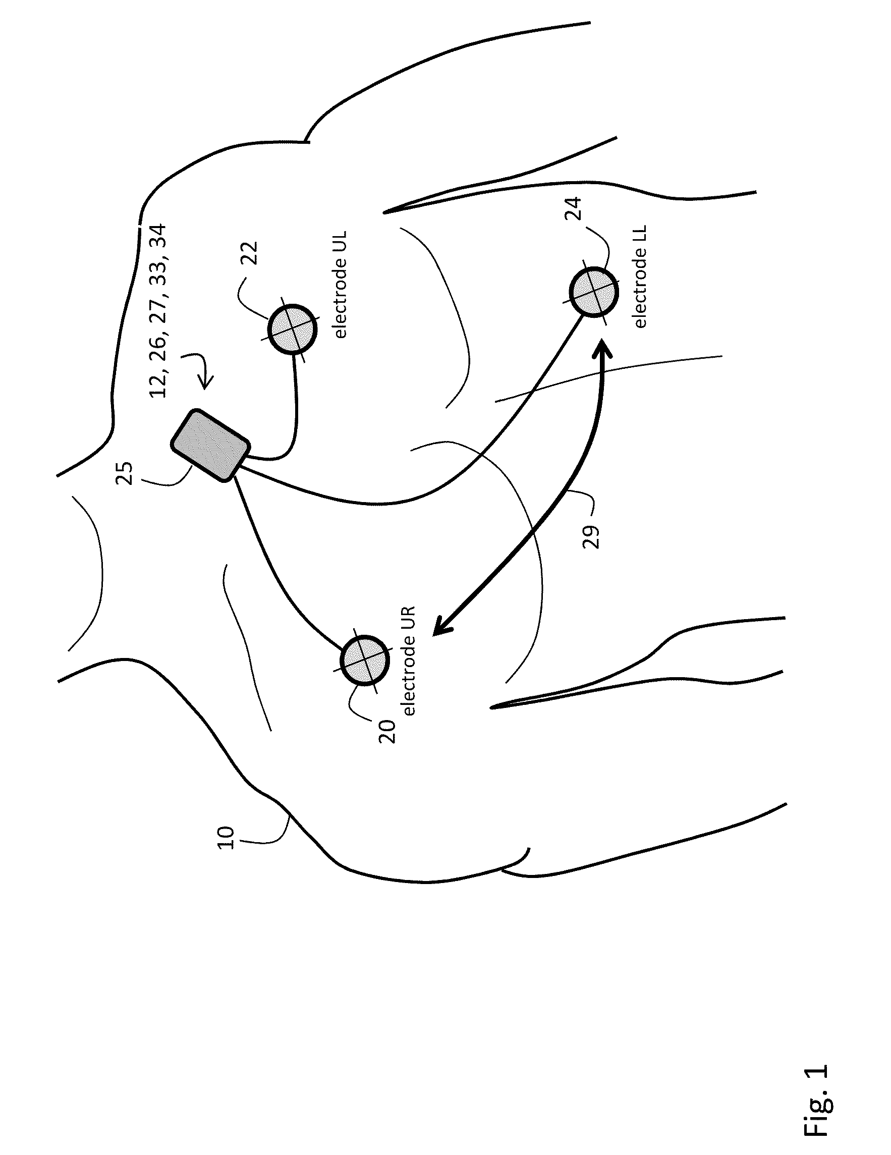 Body-worn monitor for measuring respiratory rate