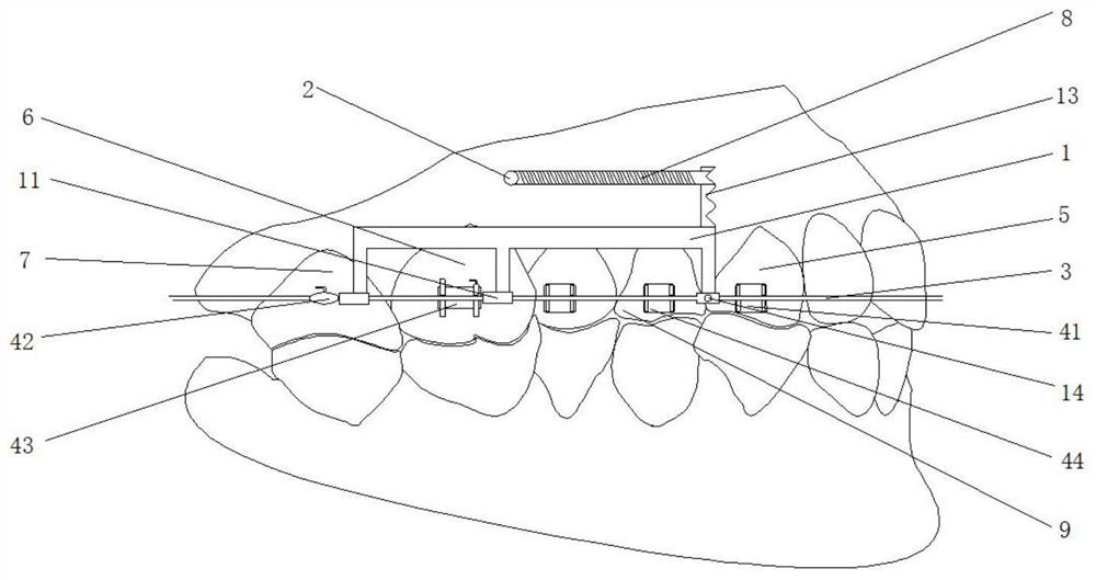 Auxiliary device for molar distal movement