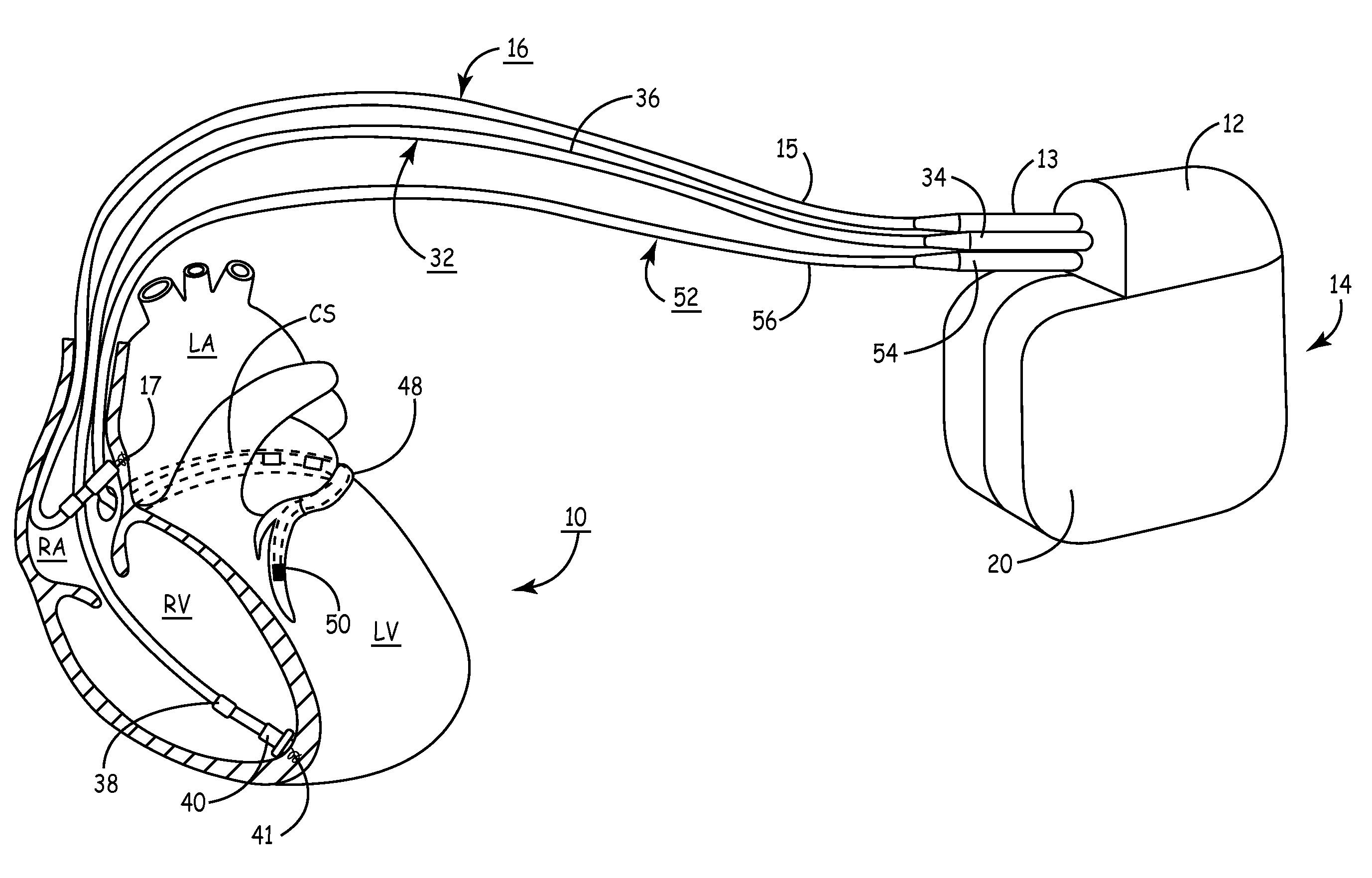 Method and apparatus for optimizing cardiac resynchronization therapy