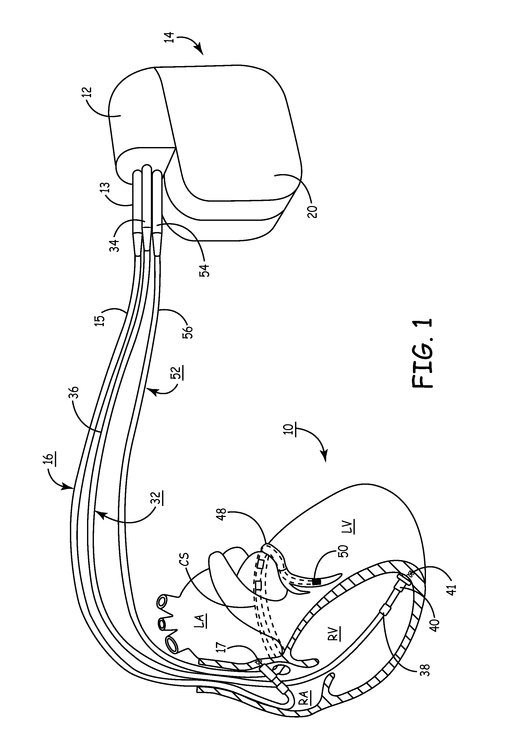 Method and apparatus for optimizing cardiac resynchronization therapy