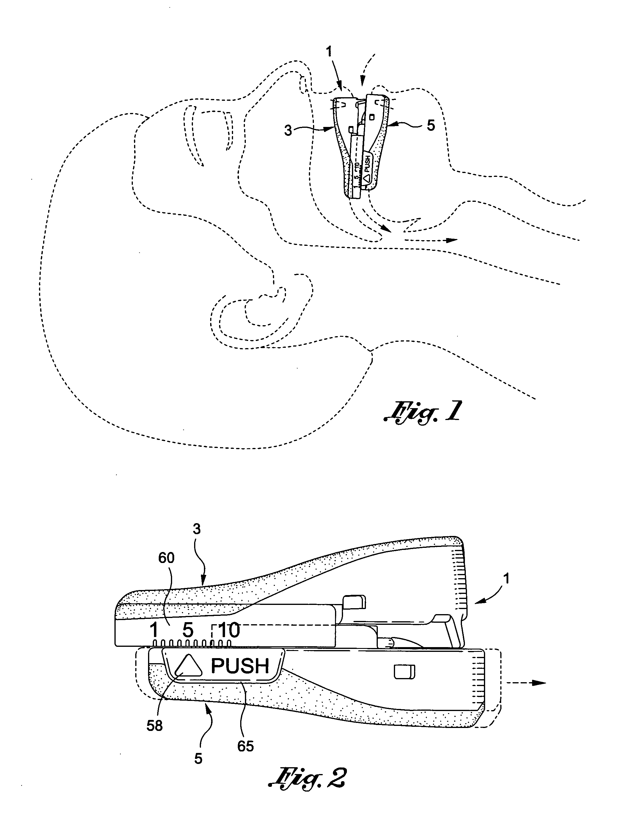 Intra-oral mandibular advancement appliance