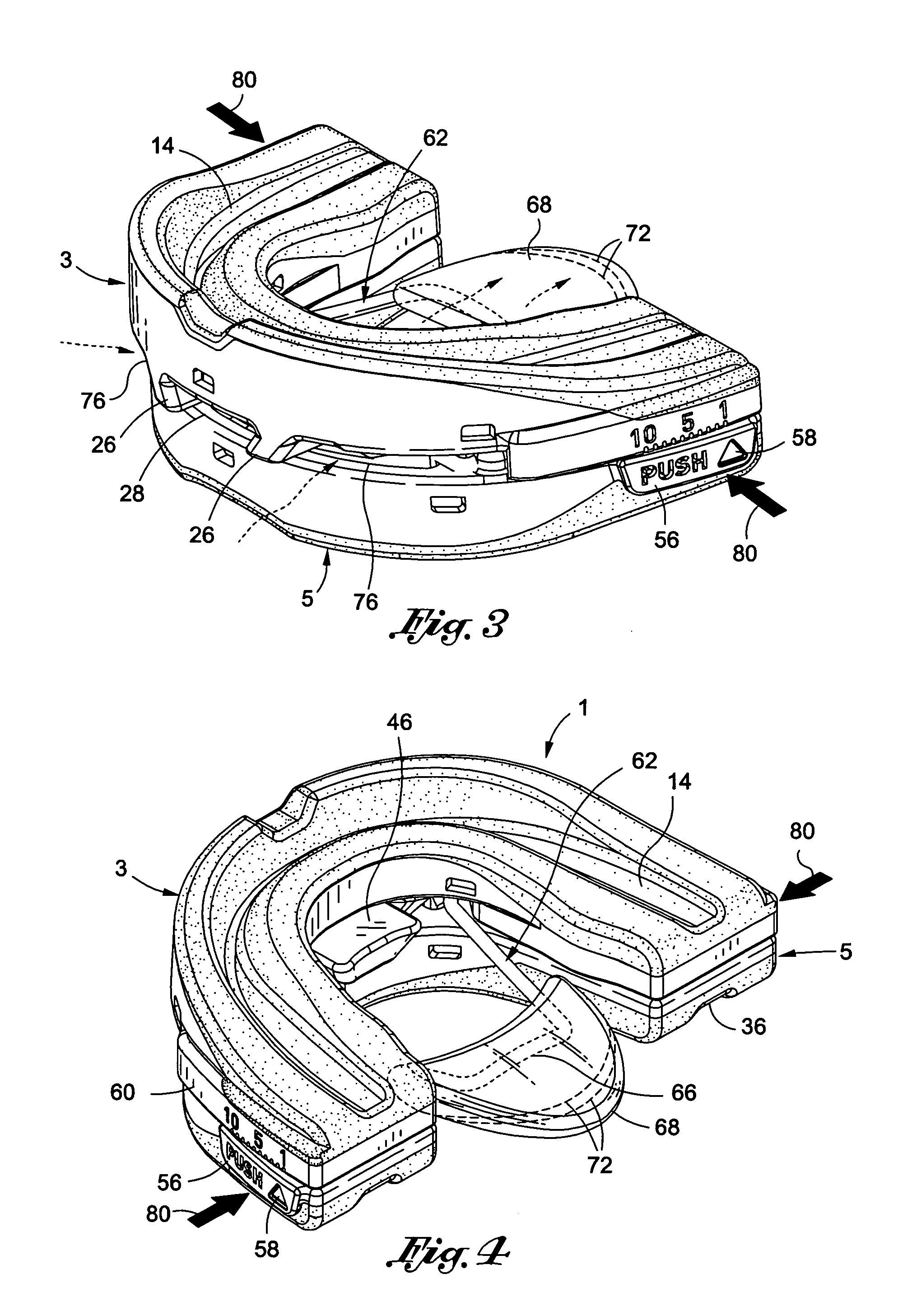 Intra-oral mandibular advancement appliance