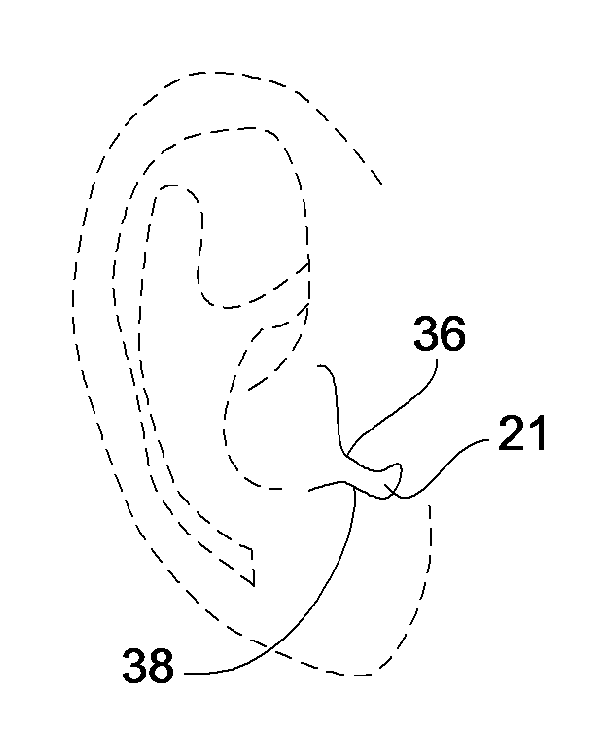 Method for Treating Headaches with Intra-Aural Devices