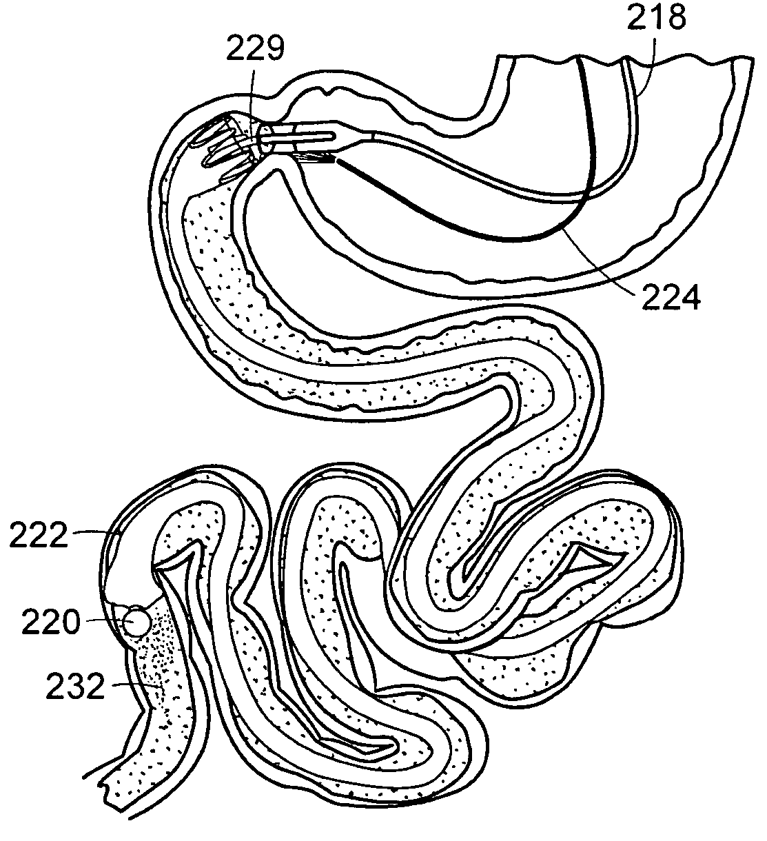 Methods and devices for placing a gastrointestinal sleeve