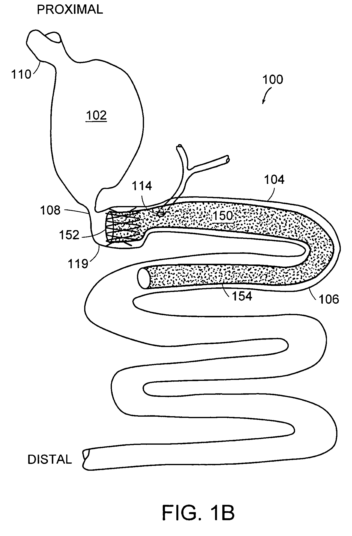 Methods and devices for placing a gastrointestinal sleeve