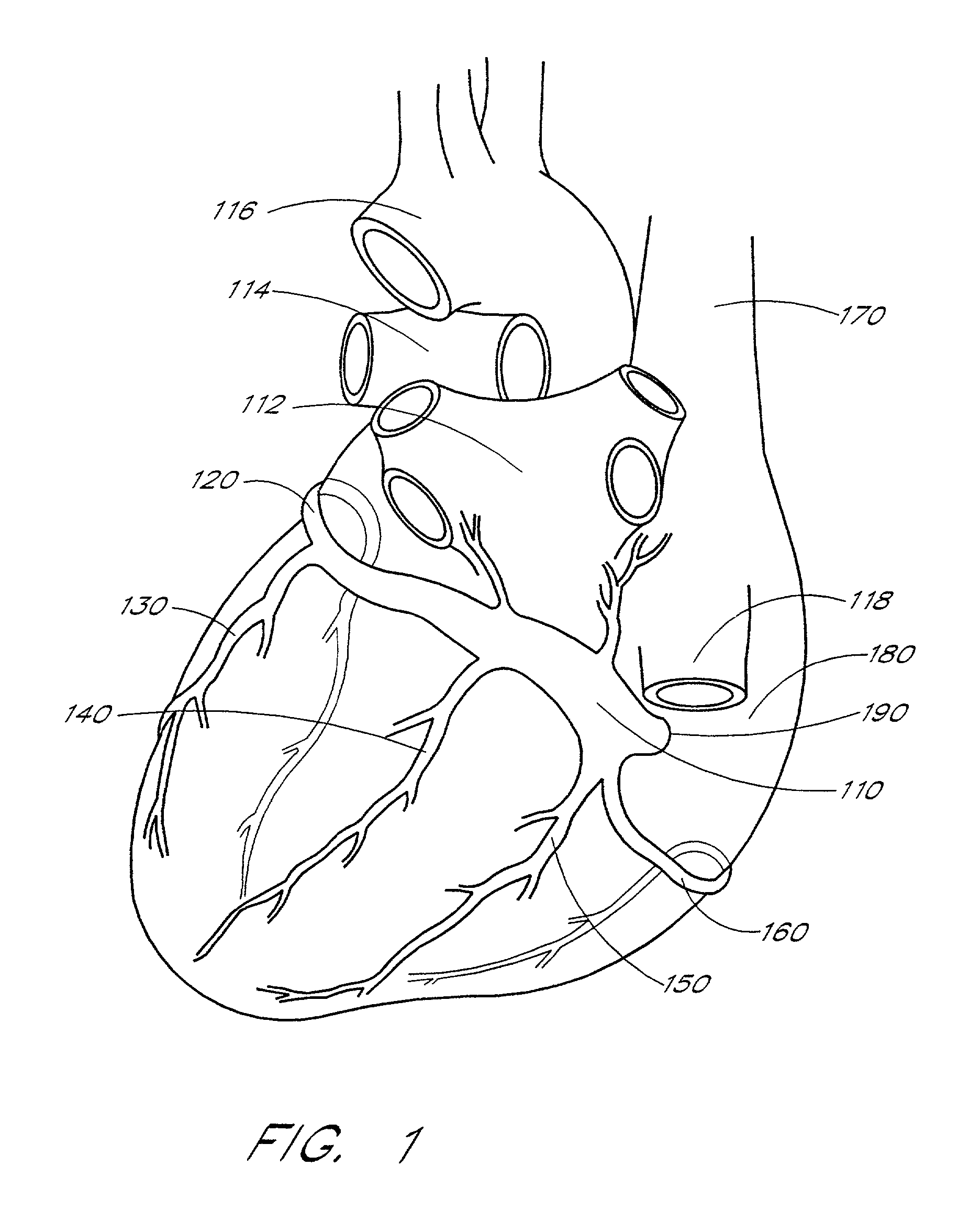 Self-anchoring coronary sinus lead