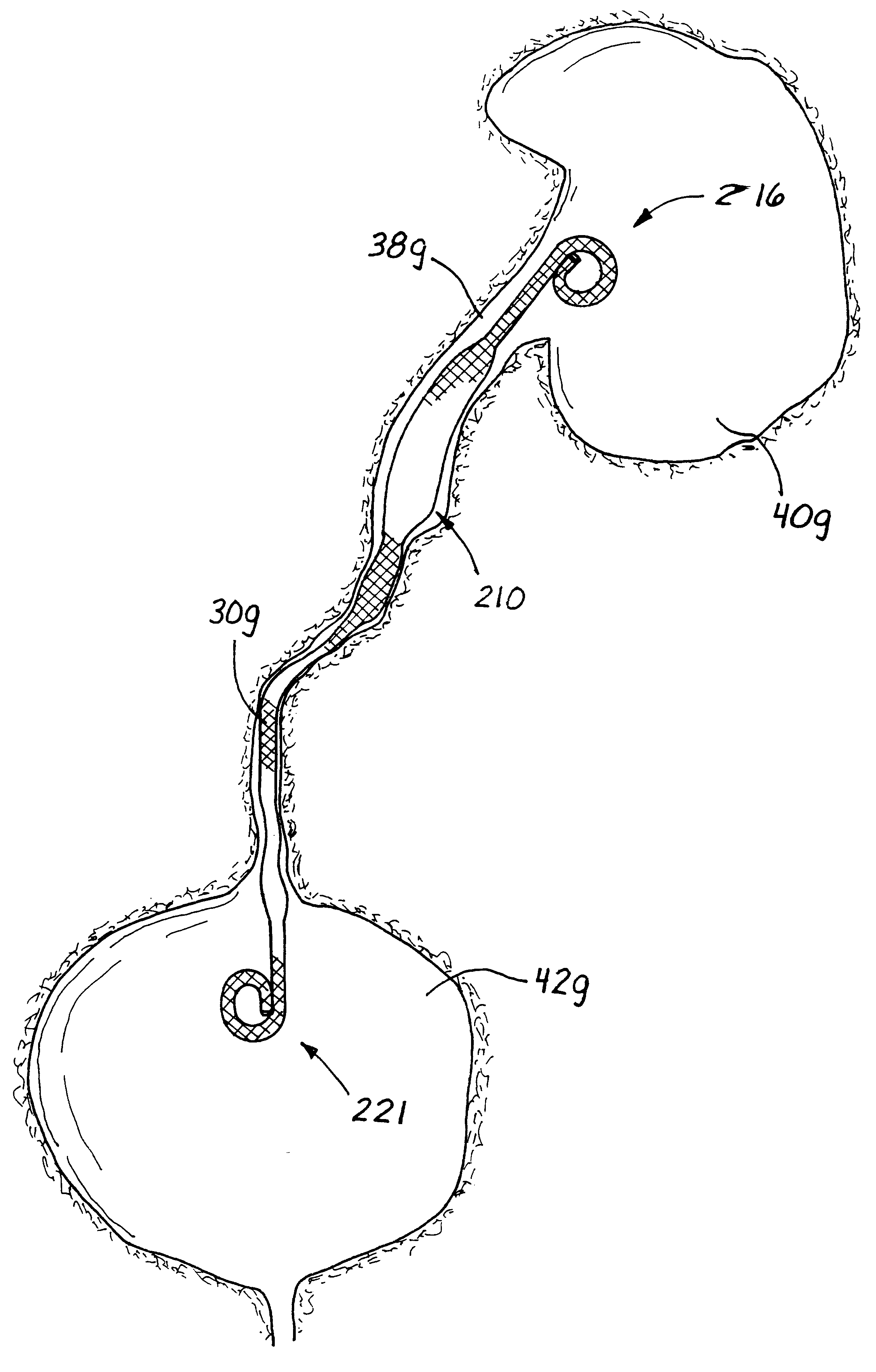 Ureteral stent system apparatus and method