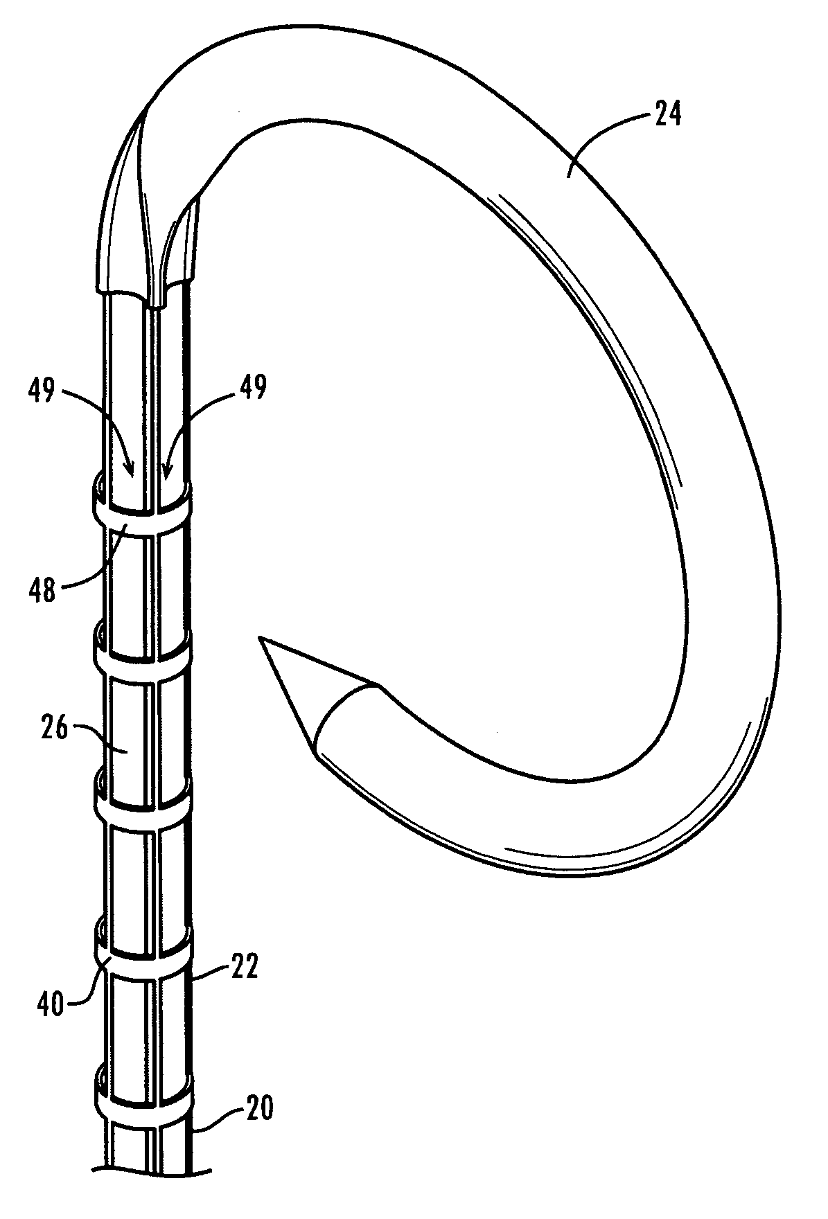 Stent improvements