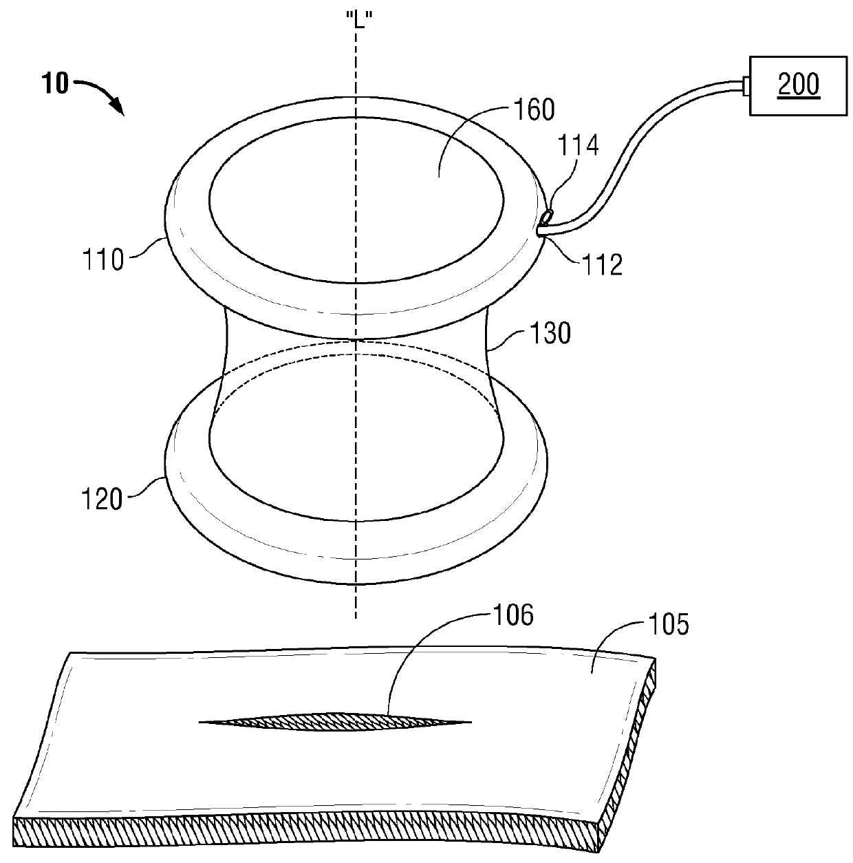 Wound retractor including rigid ring