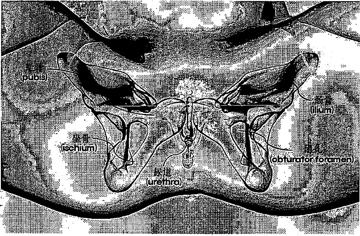 Infra-obturator tension transfer device