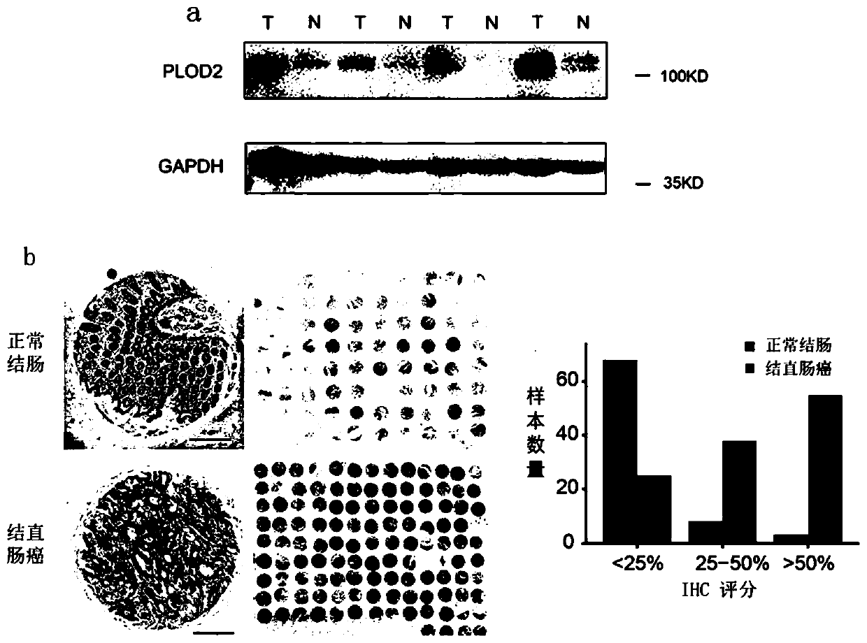 Application of small-molecule inhibitor minoxidil of PLOD2 in tumor treatment