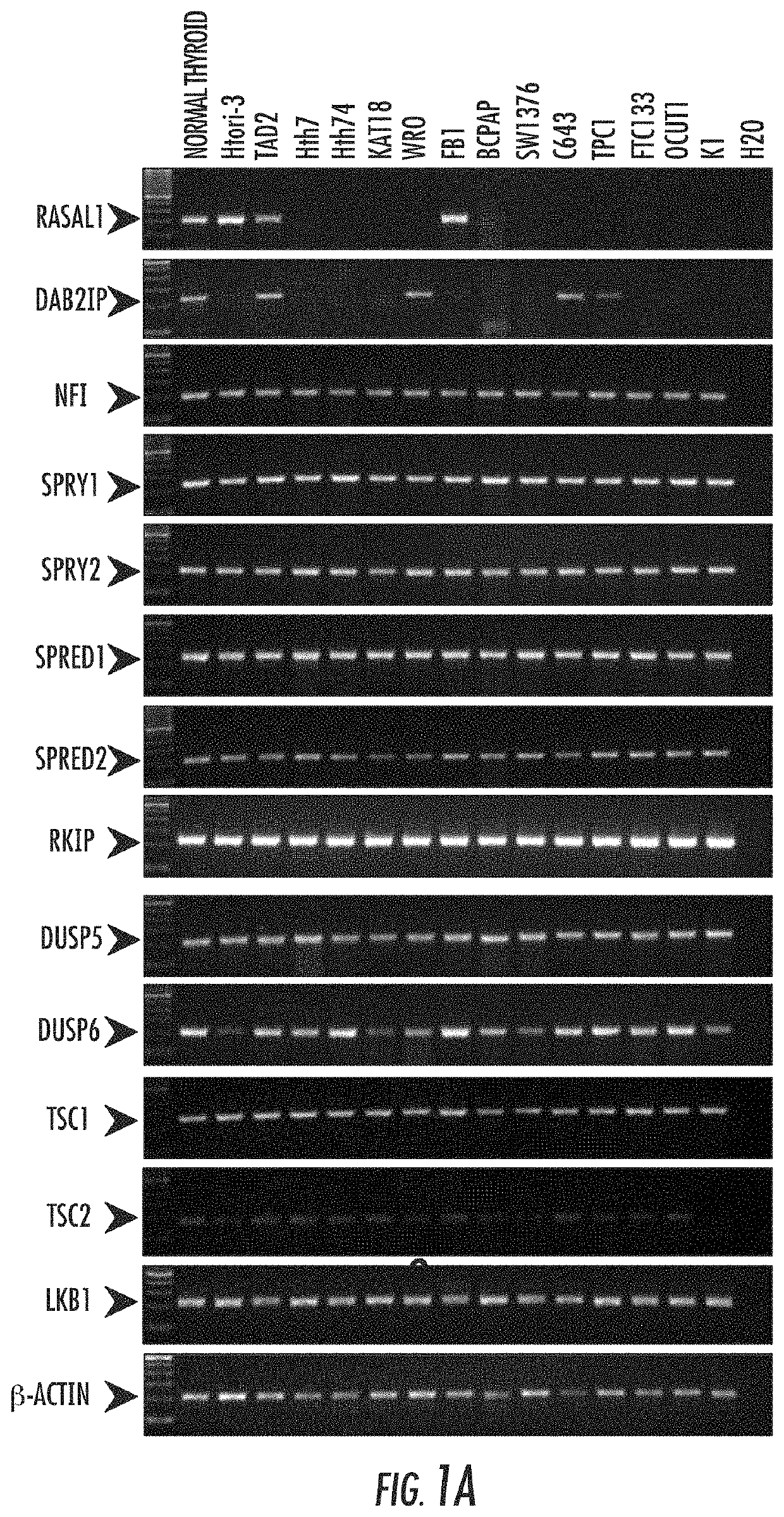 RASAL1 is a major tumor suppressor gene in thyroid cancer