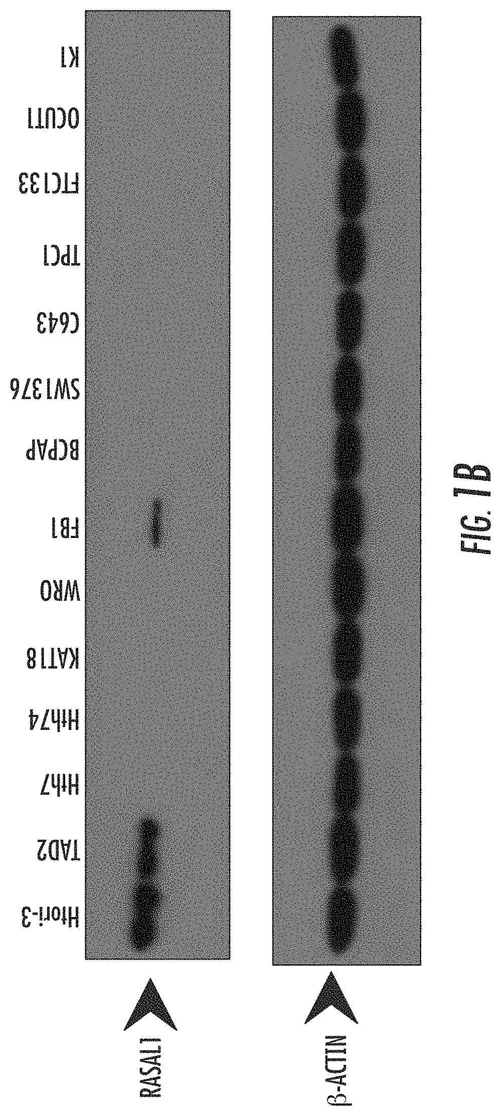 RASAL1 is a major tumor suppressor gene in thyroid cancer