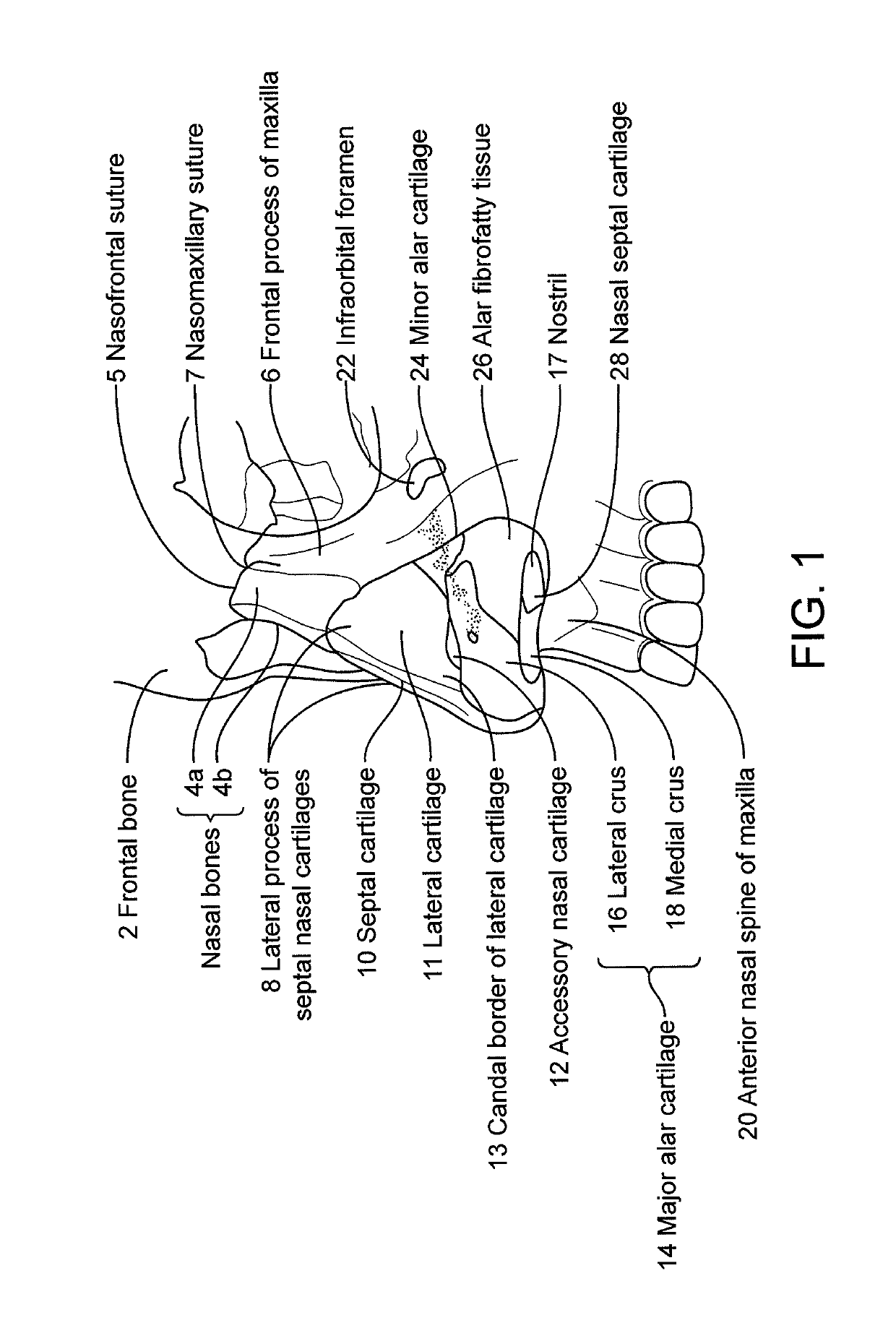 Nasal implants and systems and method of use