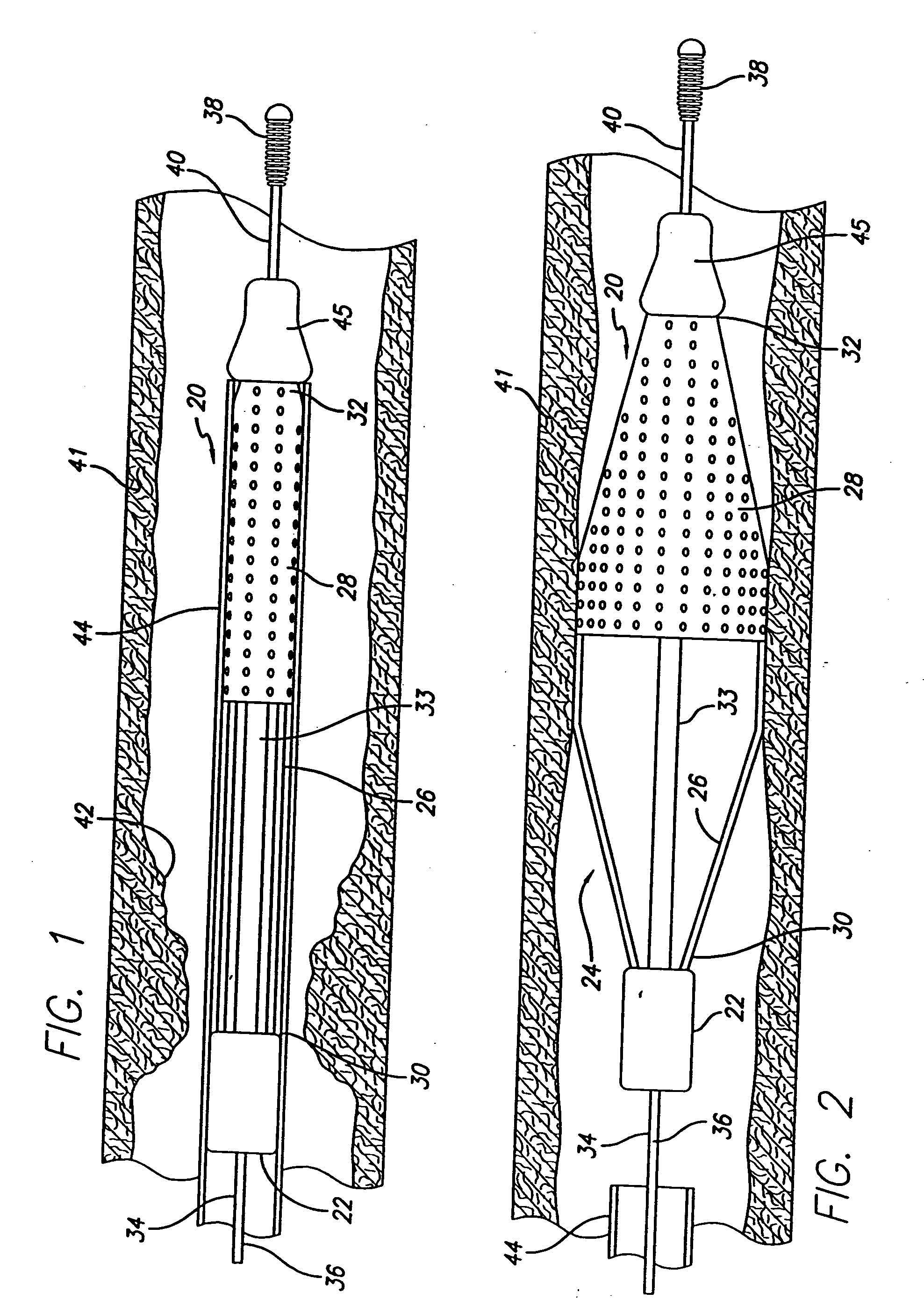 Locking component for an embolic filter assembly