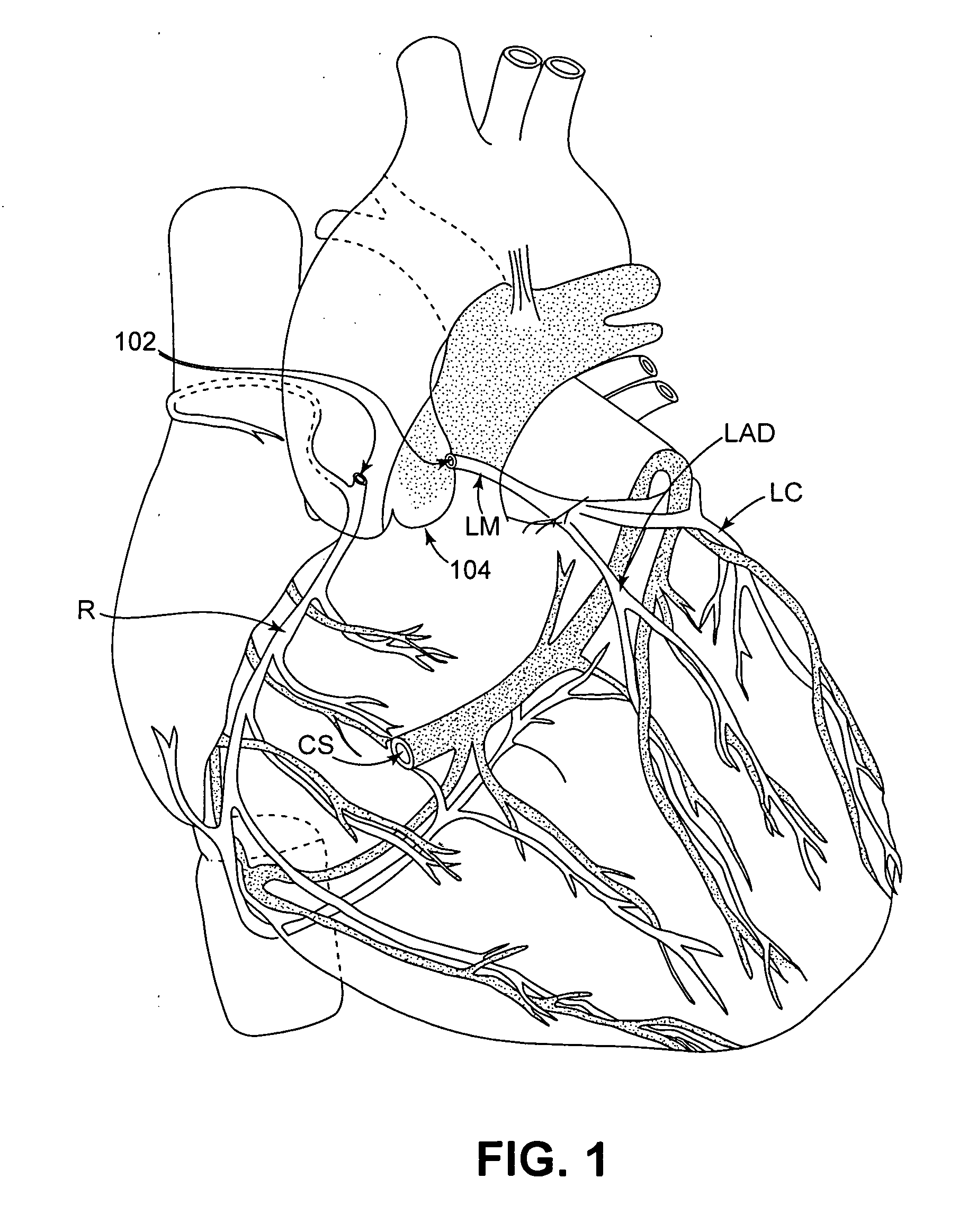 Isolating cardiac circulation