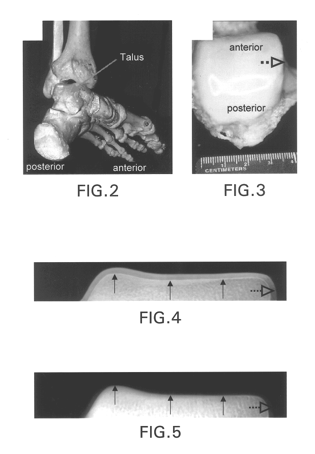 Diffraction enhanced x-ray imaging of articular cartilage