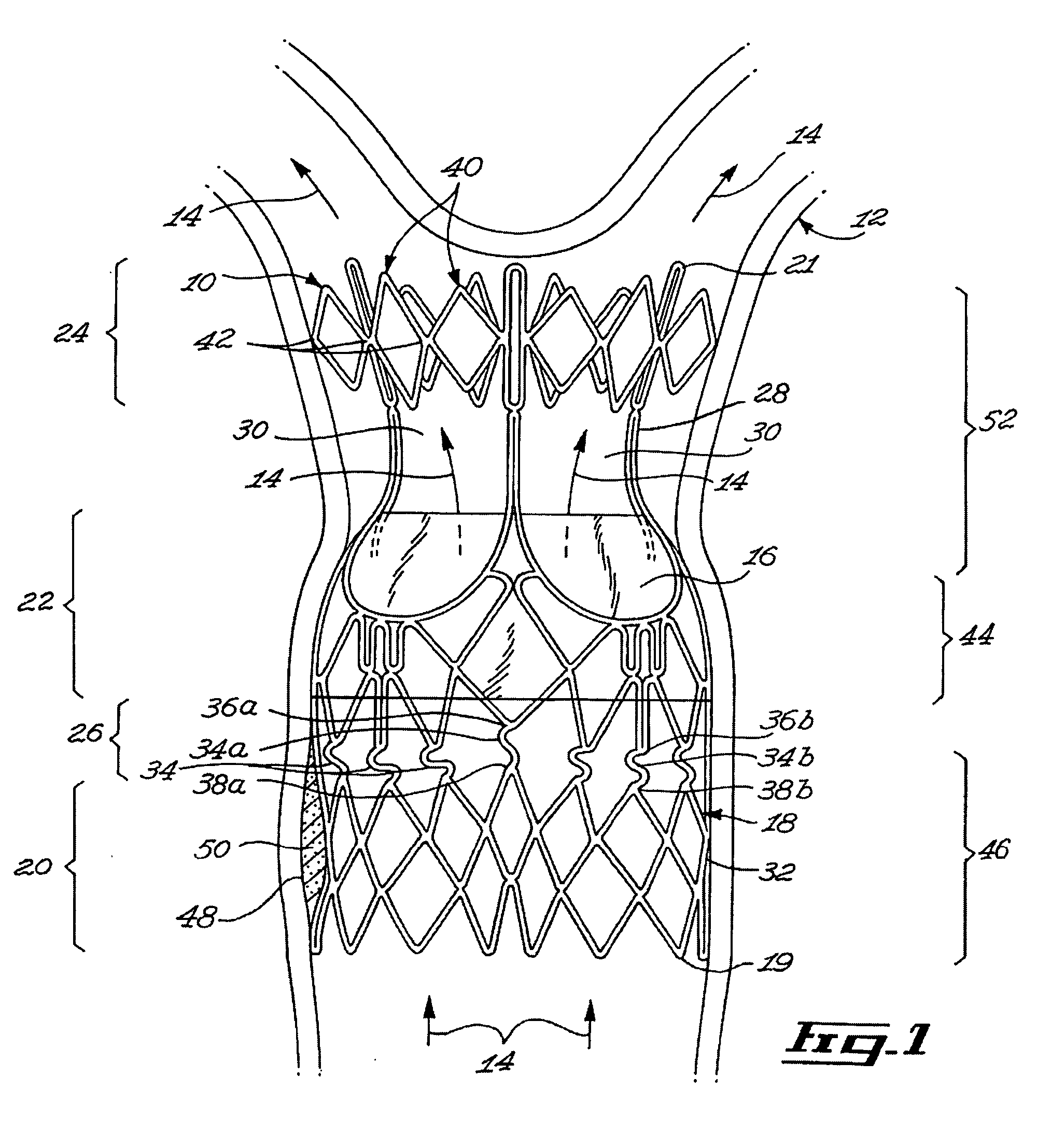 Stent valve and method of using same