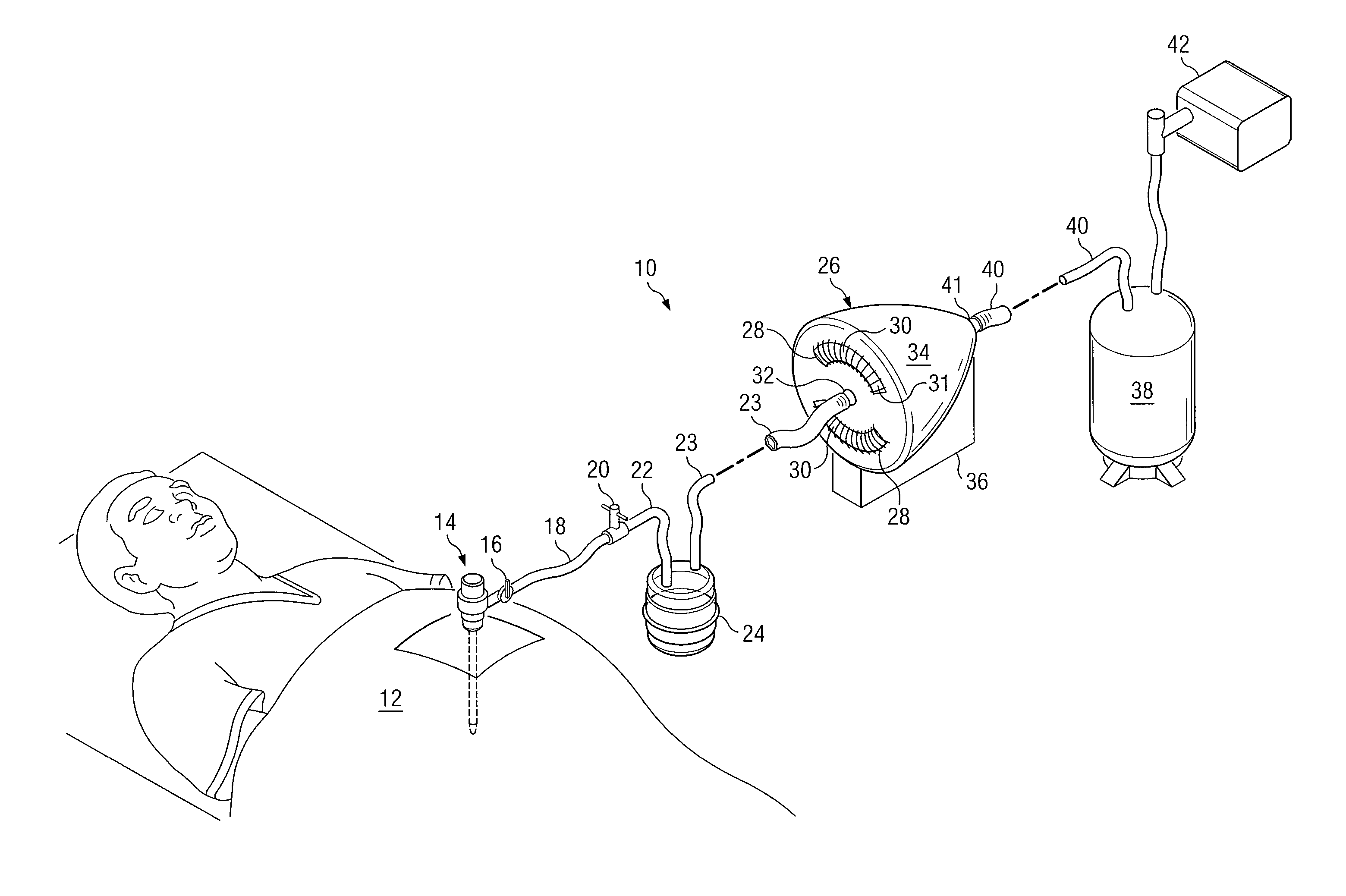 System and method to vent gas from a body cavity