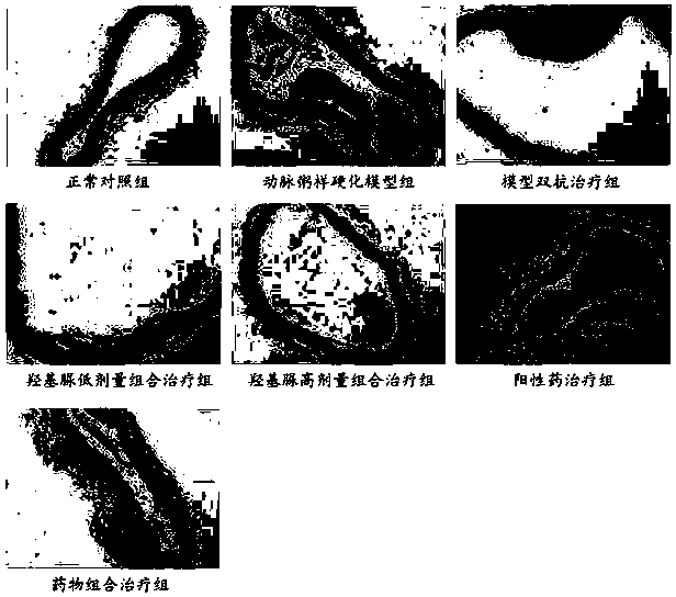 Application of pharmaceutical composition containing hydroxyurea