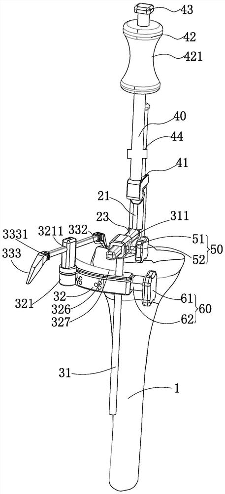 A tibial osteotomy guide