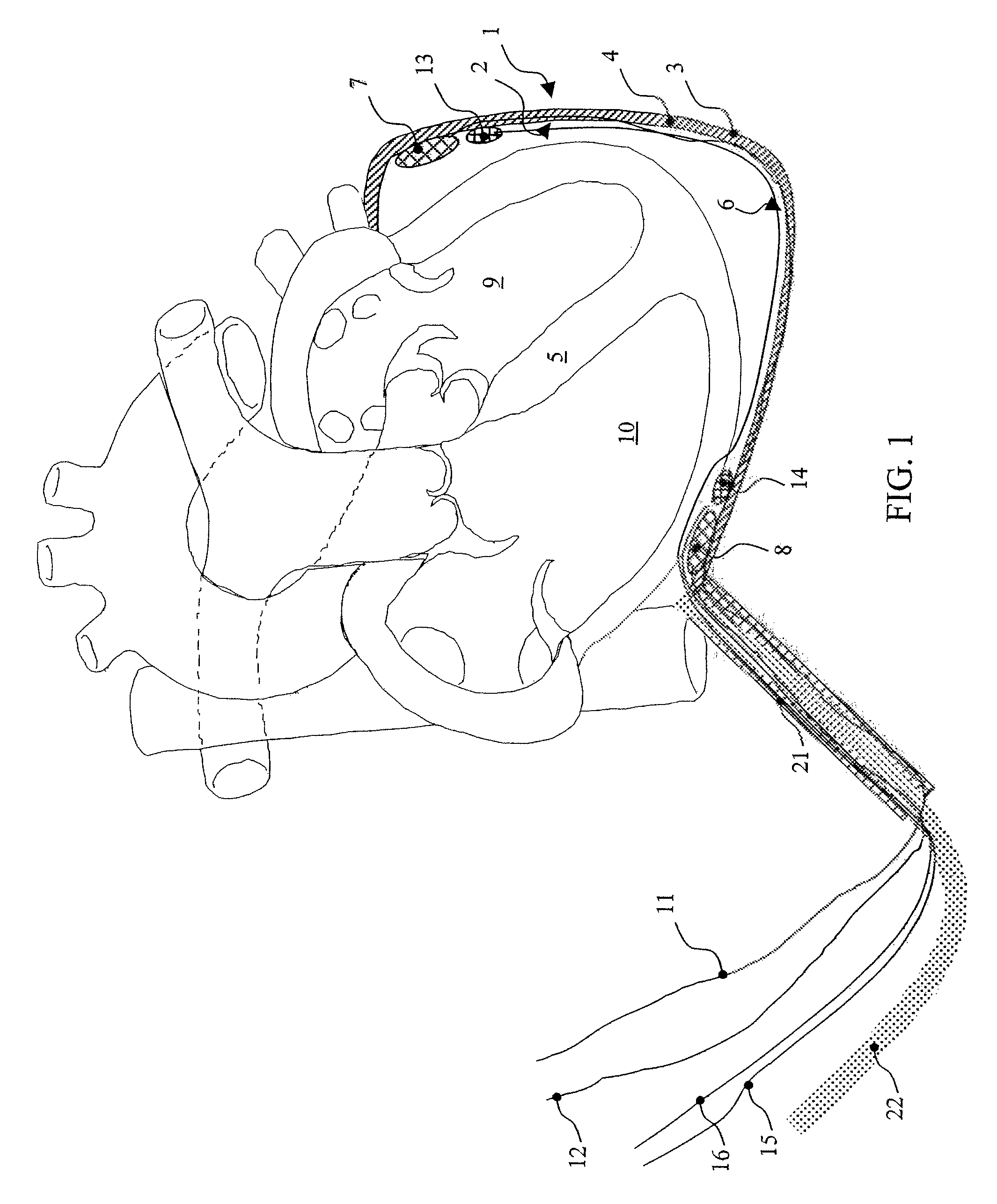 Device for the epicardial support and/or resumption of cardiac activity