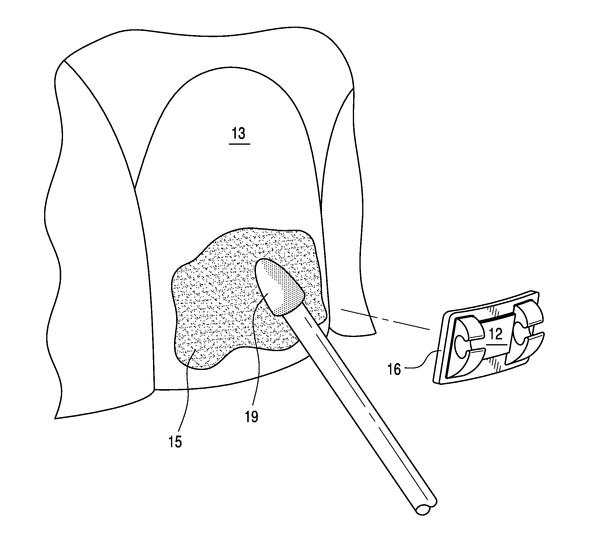 Adjustable orthodontic bracket and method using a microstructured shape memory polymer surface with reversible dry adhesion