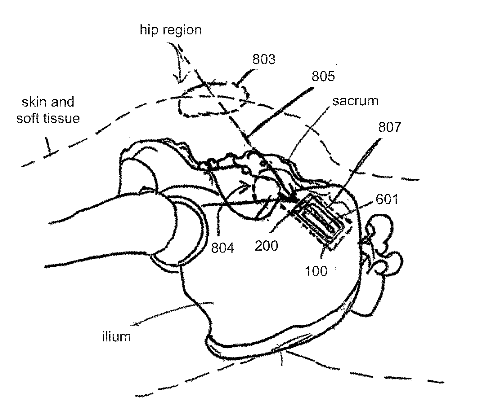 Sacroiliac Joint Implants and Implantation Methods