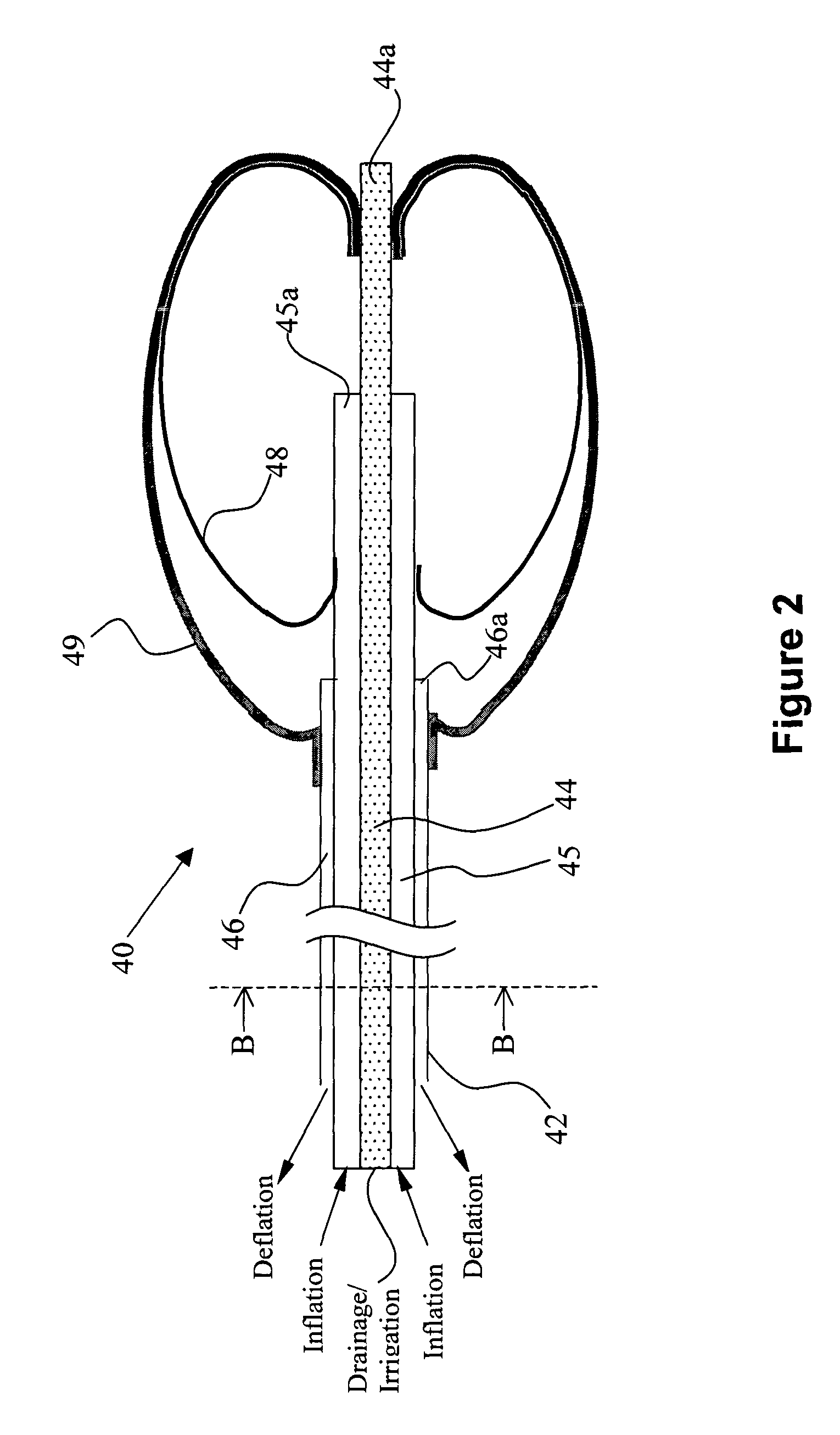 Inflatable dual balloon catheter