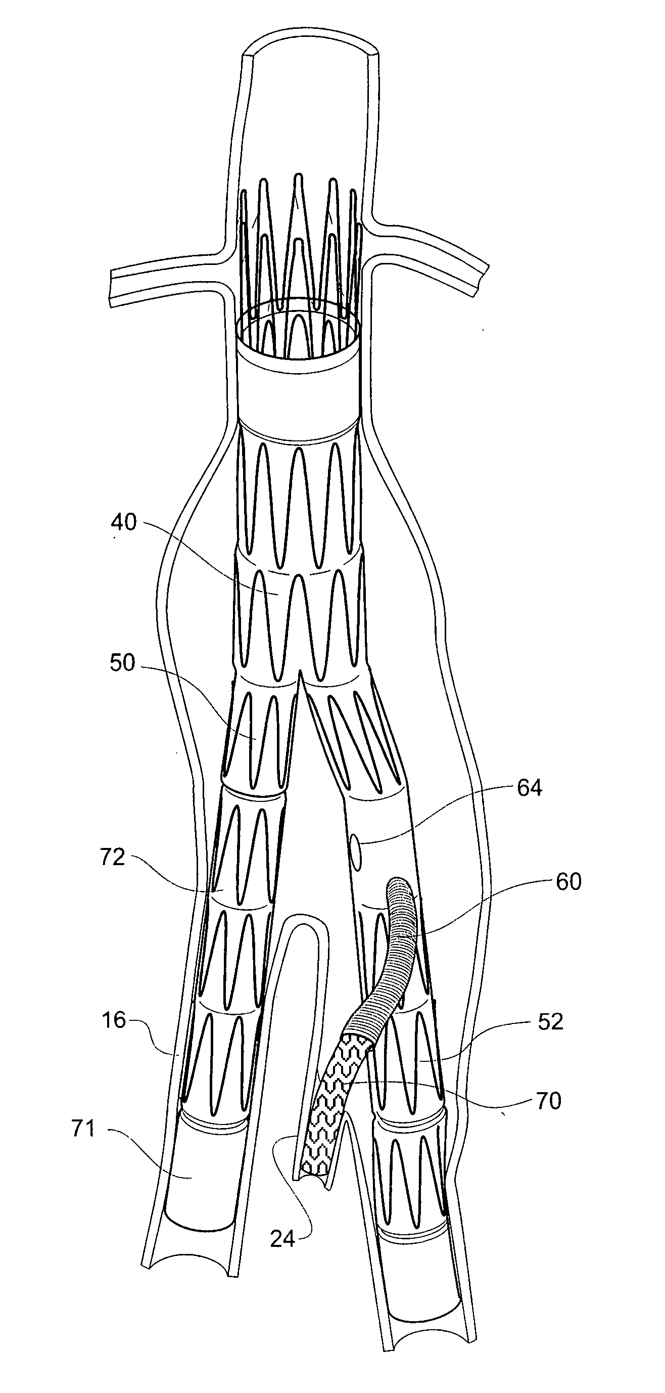 Twin bifurcated stent graft