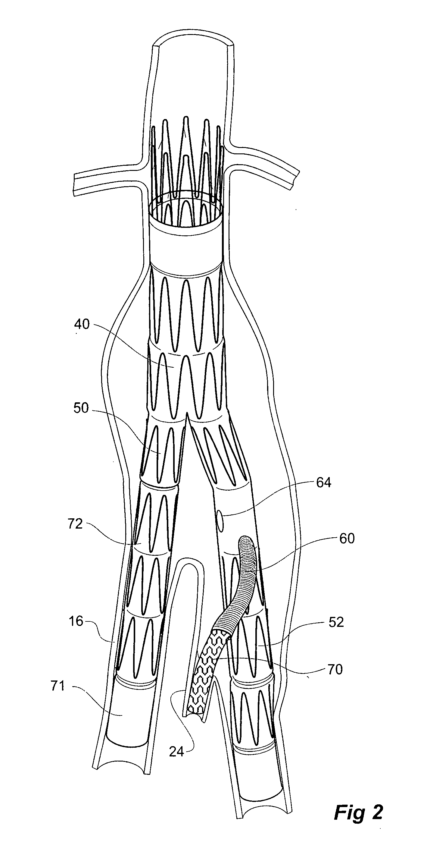 Twin bifurcated stent graft