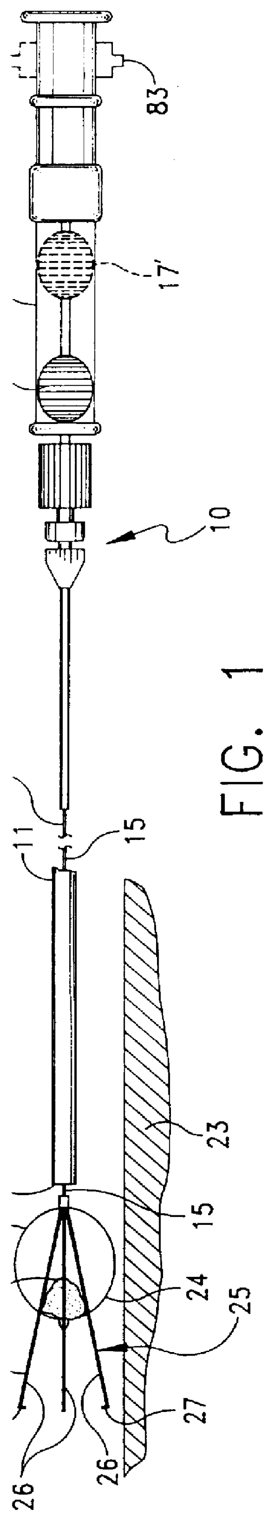 Method and apparatus for severing and capturing polyps