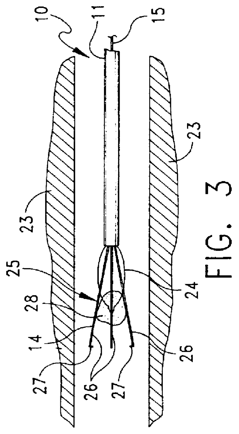 Method and apparatus for severing and capturing polyps